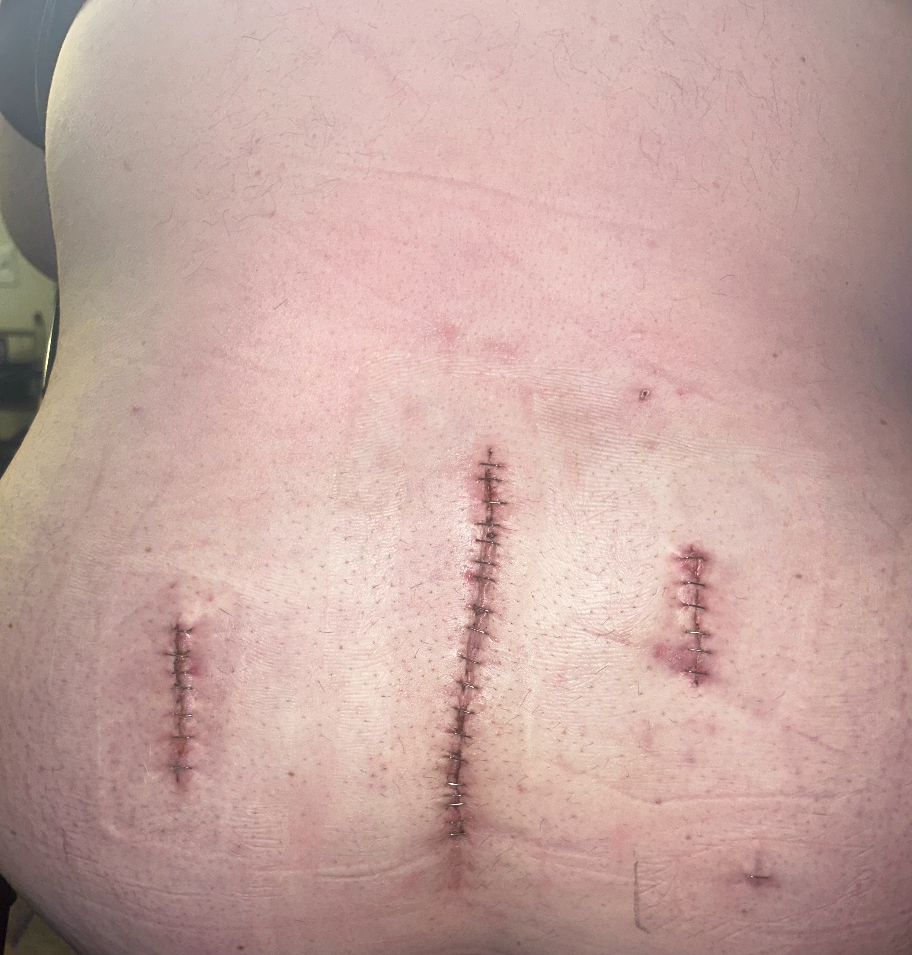 Supporting Our Family Post Back Surgeries campaign photo, 2 of 7