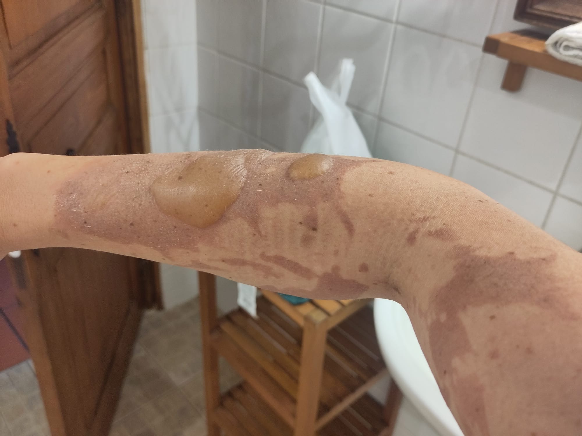 From Severe Burns to a Stolen Camper – Help Me Start Over campaign photo, 4 of 8