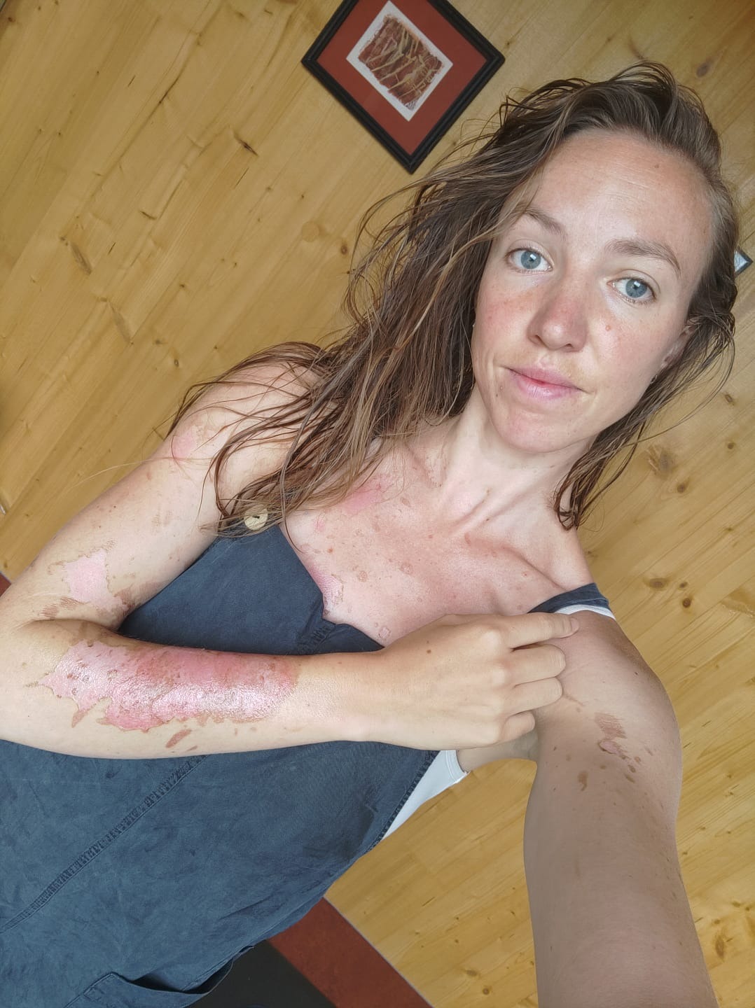 From Severe Burns to a Stolen Camper – Help Me Start Over campaign photo, 5 of 8
