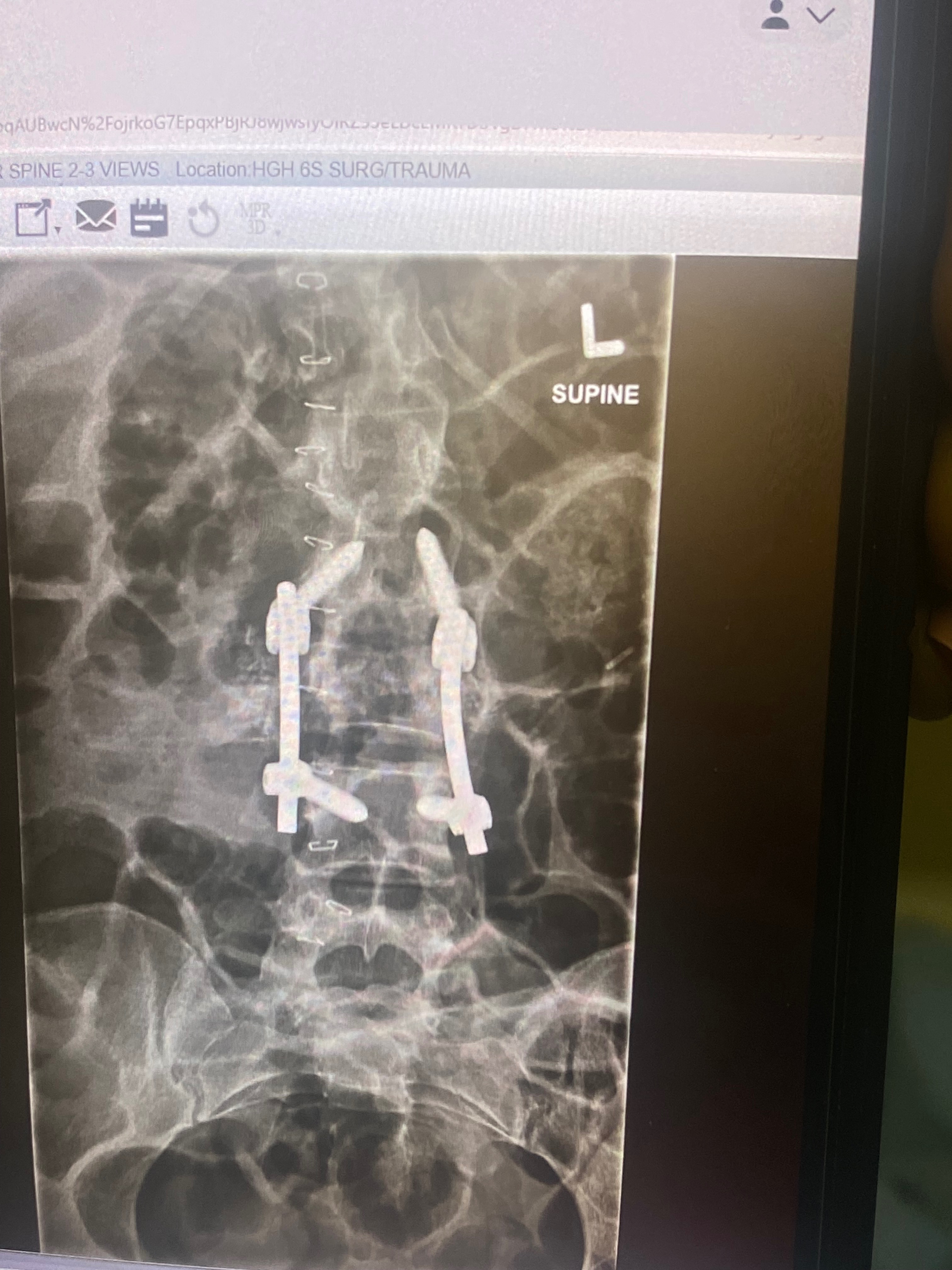 Support Sheena’s Recovery from Paraplegia campaign photo, 4 of 6