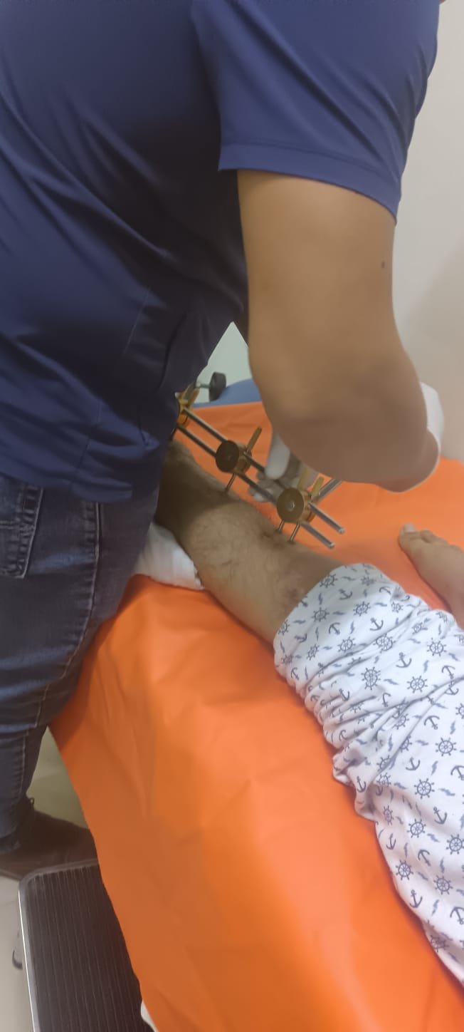 Save Victor's Leg: Urgent Medical Help Needed campaign photo, 4 of 8