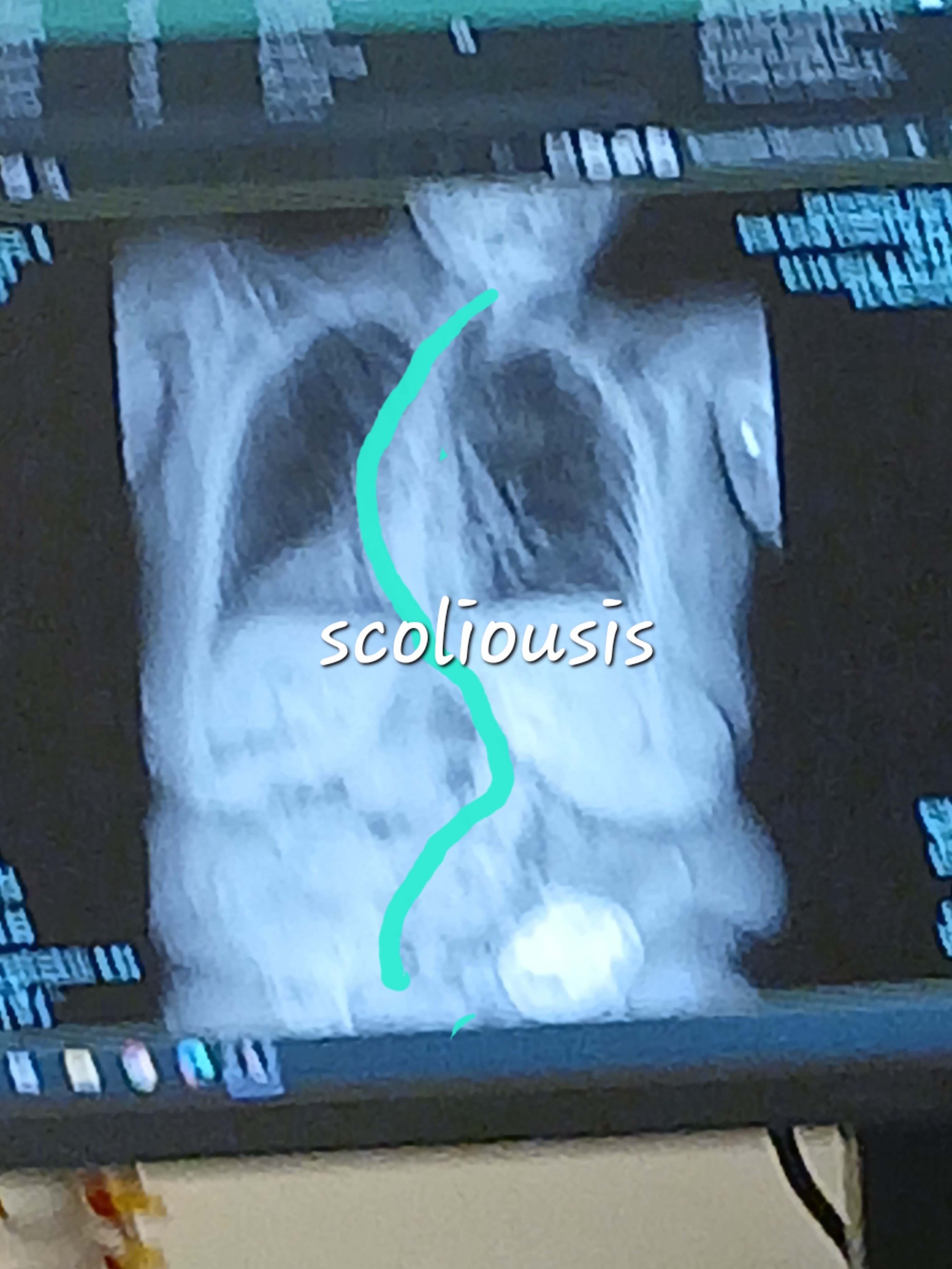 Support Tammy's Surgery, I have crippling scoliosis & steop campaign photo, 4 of 7