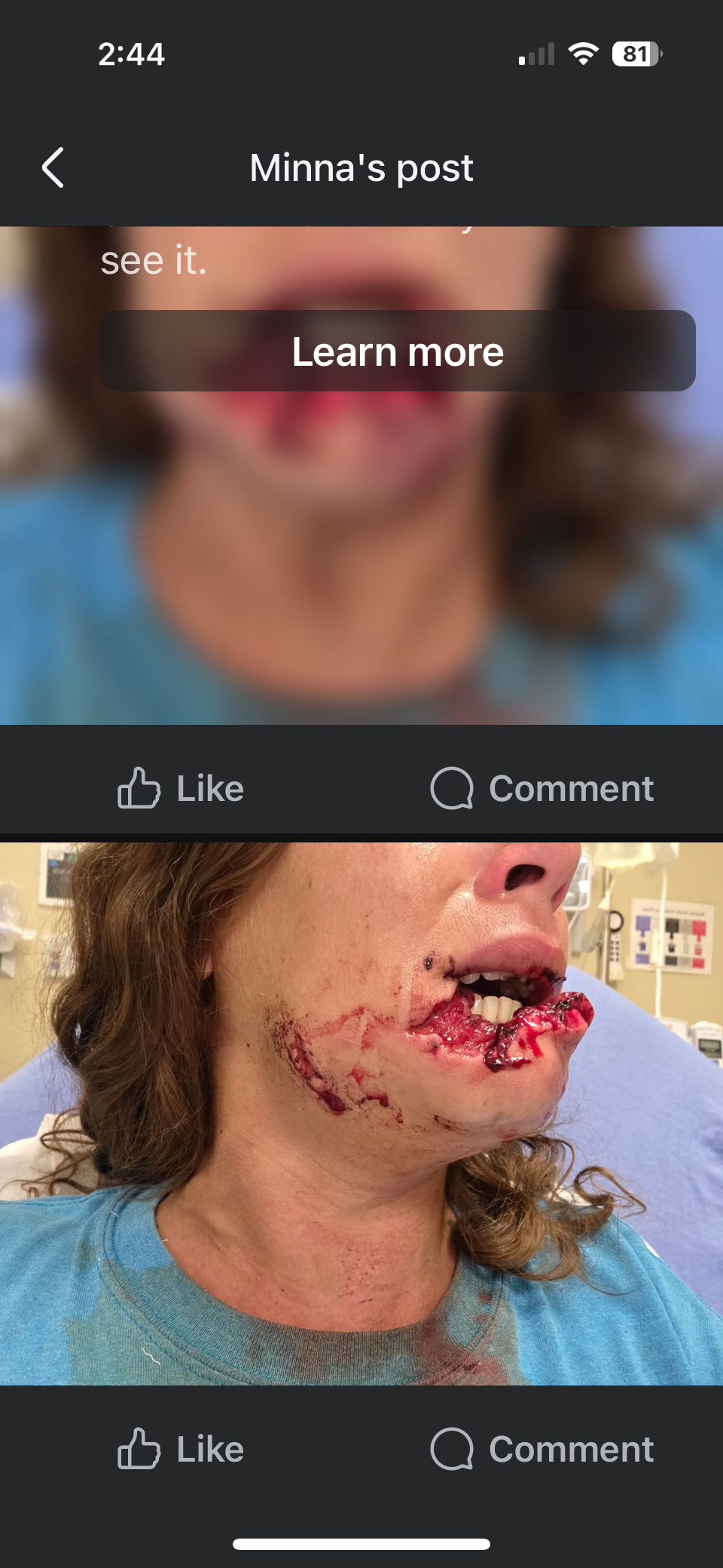 Help Minna Heal From A Tragic Dog Attack... campaign photo, 5 of 6