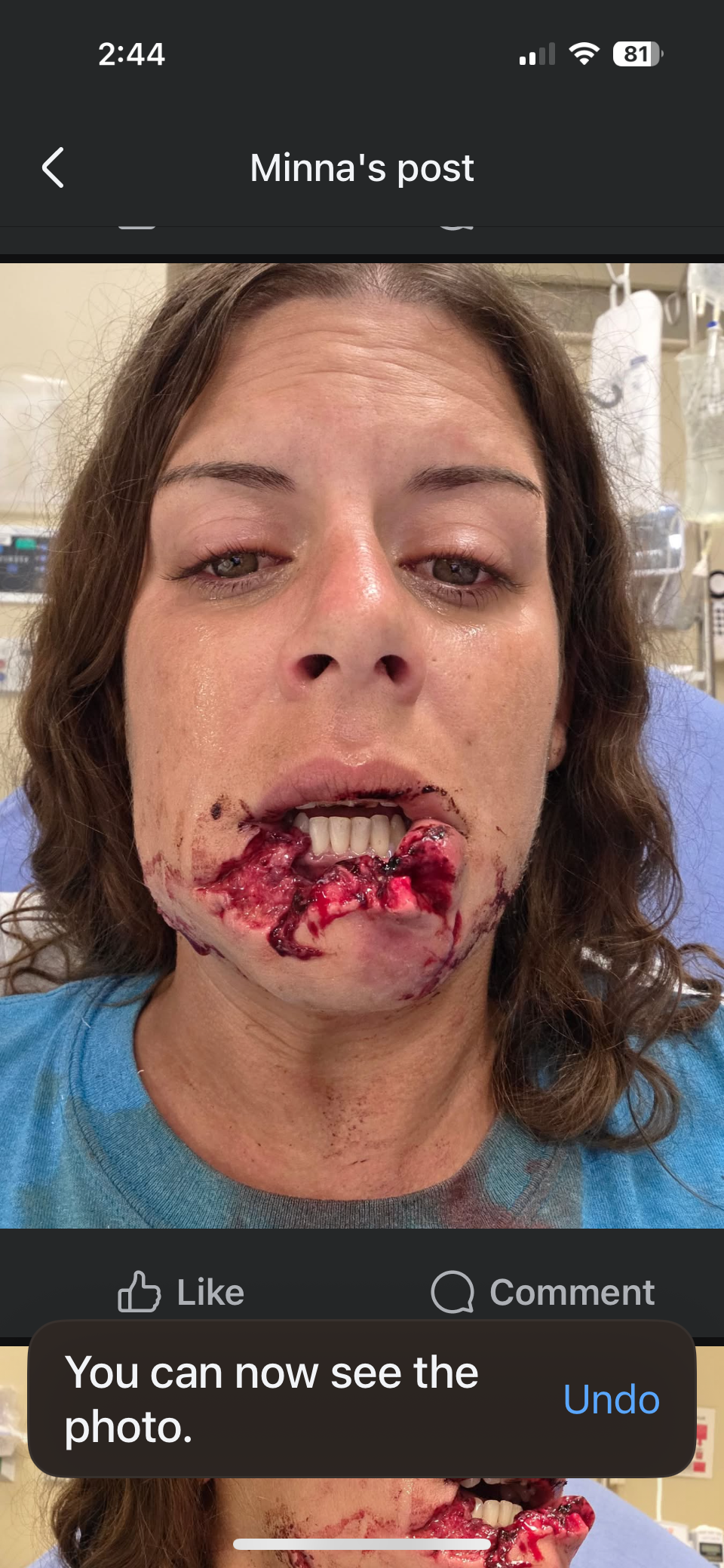Help Minna Heal From A Tragic Dog Attack... campaign photo, 2 of 6