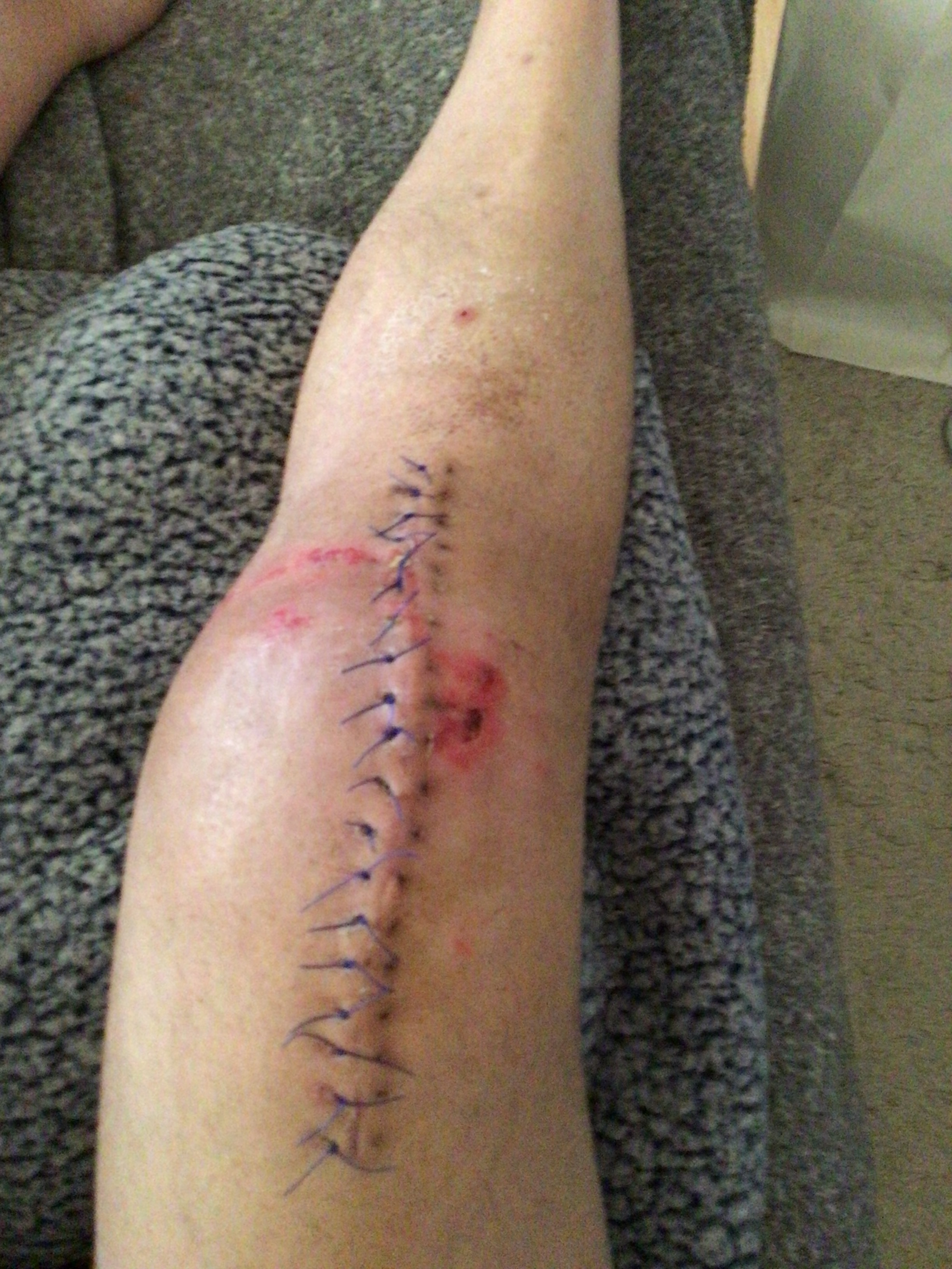 A 3rd critical surgery, 2 weeks, July 28…a continuation. campaign photo, 6 of 8