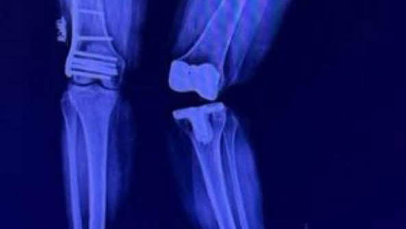 Fracture to Freedom: Suzy’s Recovery Fund photo