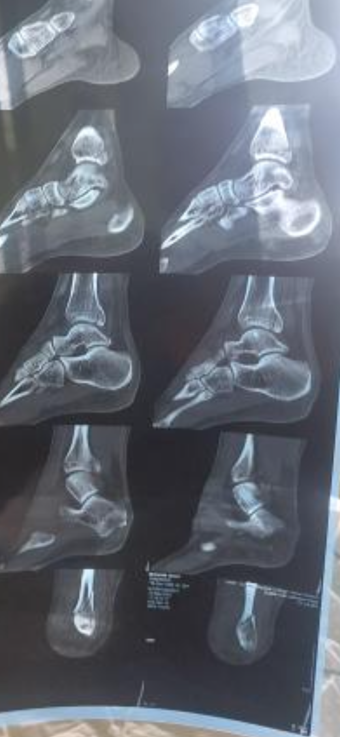 Help Shuvam afford his ankle surgery campaign photo, 2 of 5
