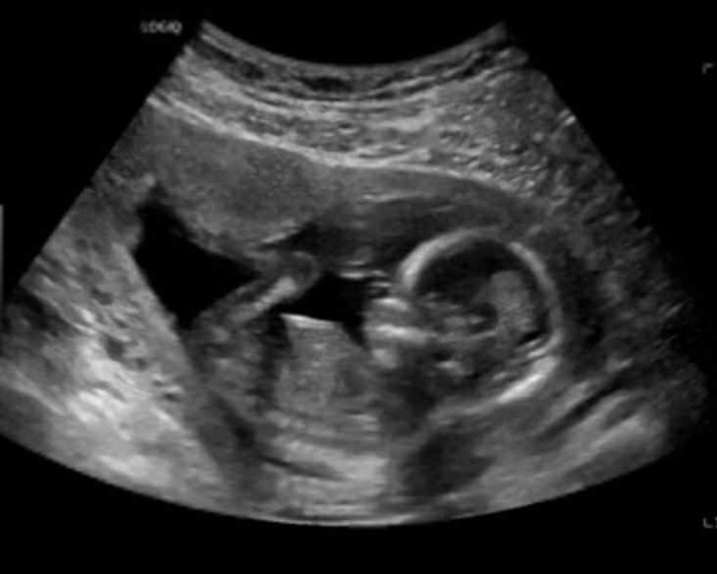 Baby Mariana campaign photo, 2 of 4