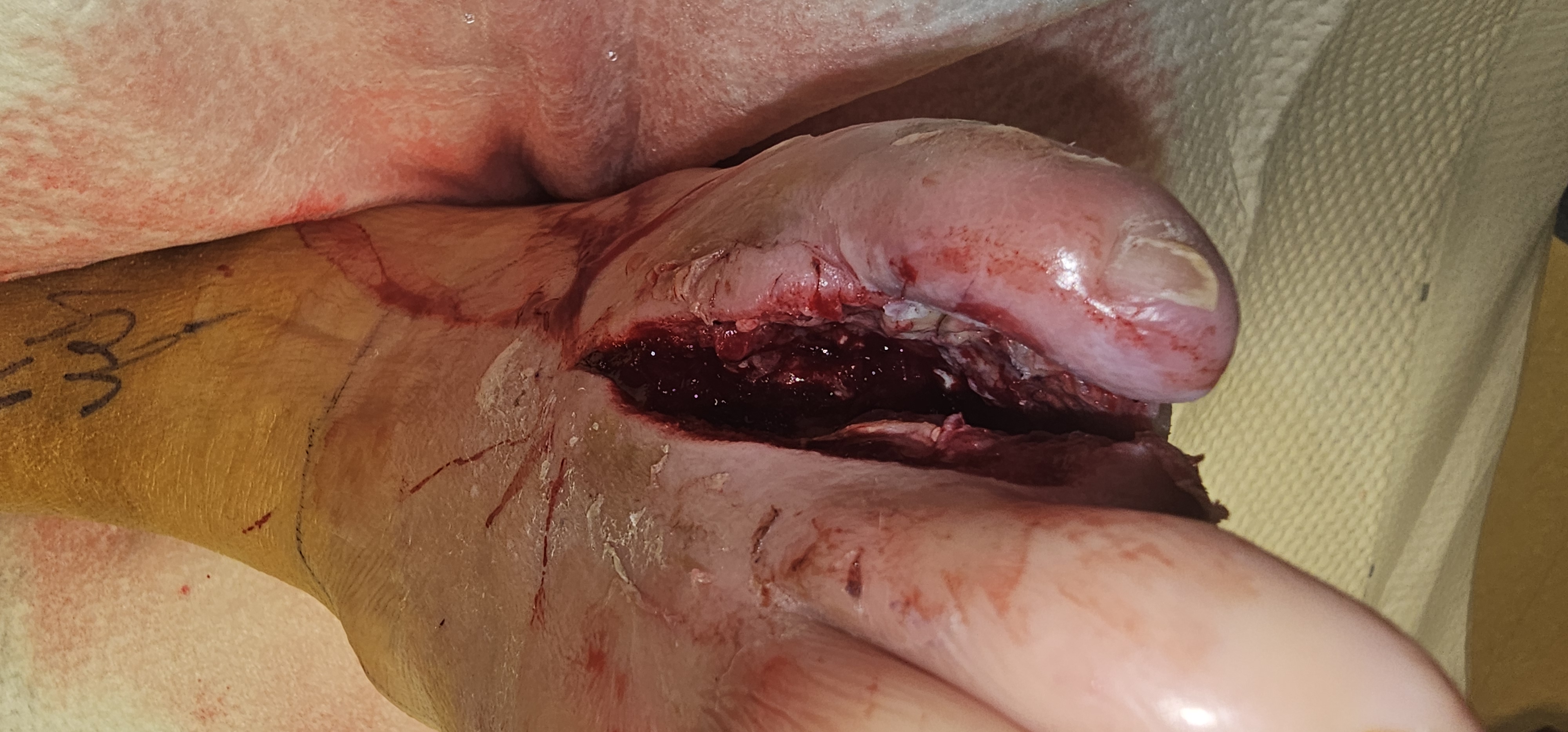Support Craig's Recovery from Amputation campaign photo, 2 of 7