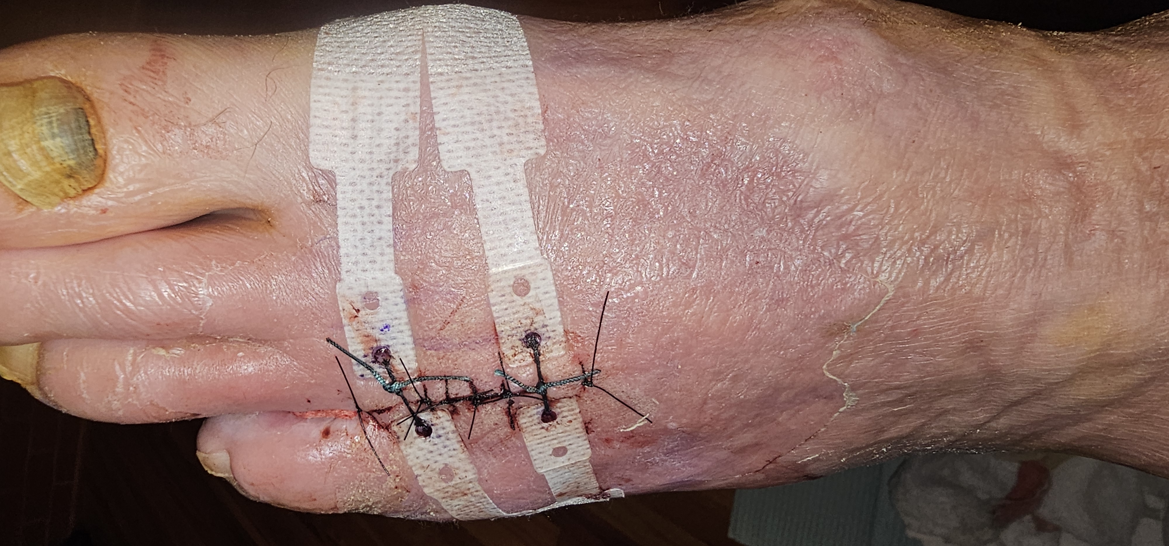 Support Craig's Recovery from Amputation campaign photo, 4 of 7