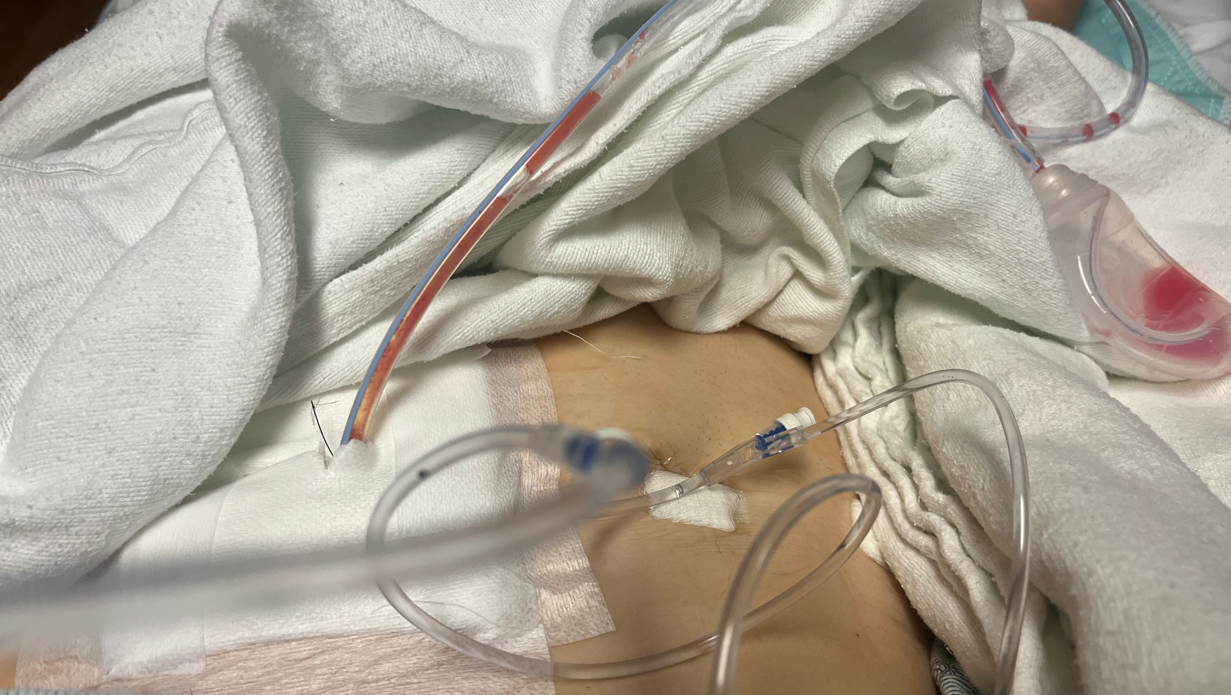 Mom that needs help after emergency surgery photo