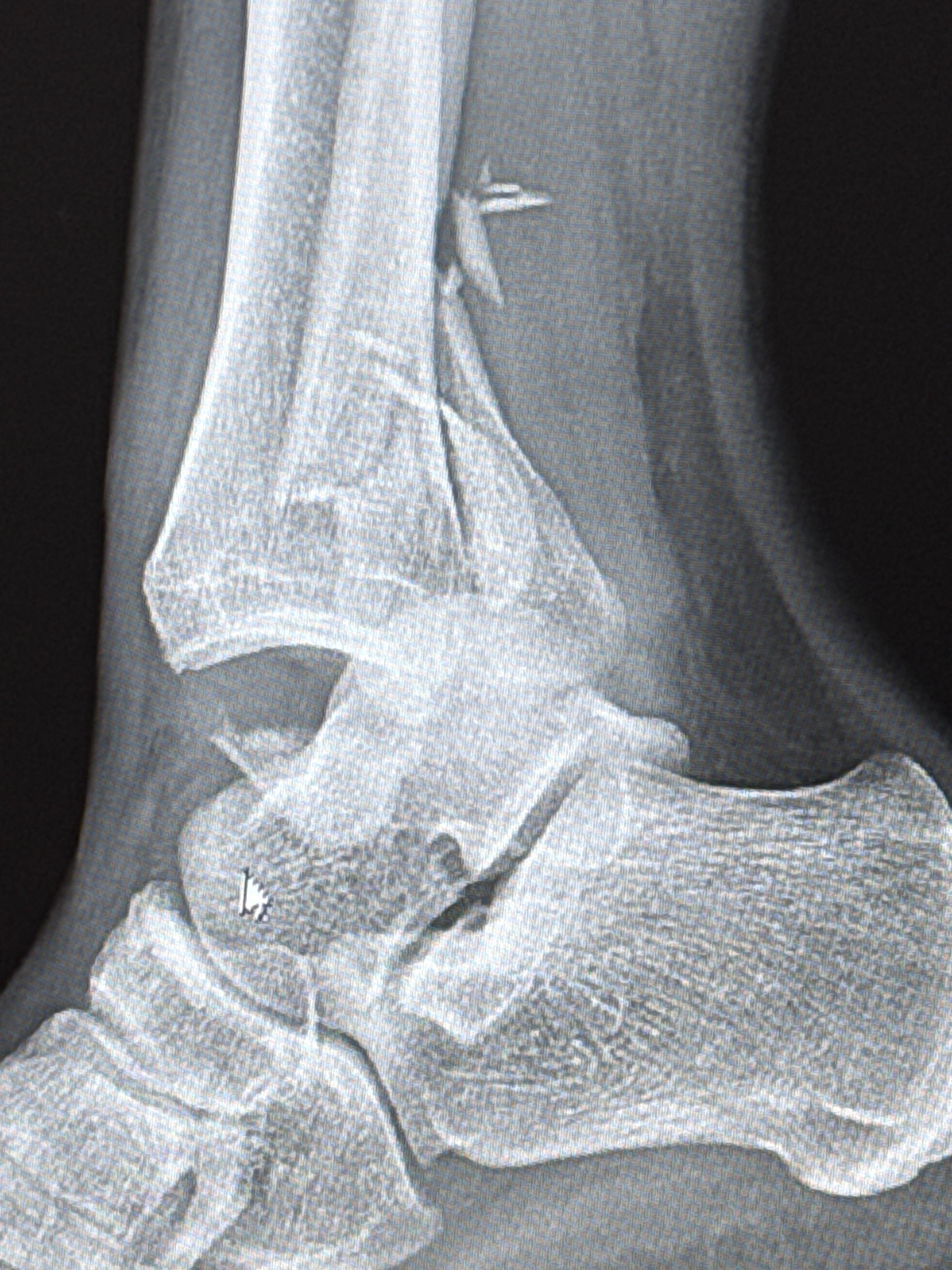 Support CJ's Recovery from Wrestling Injury campaign photo, 2 of 5