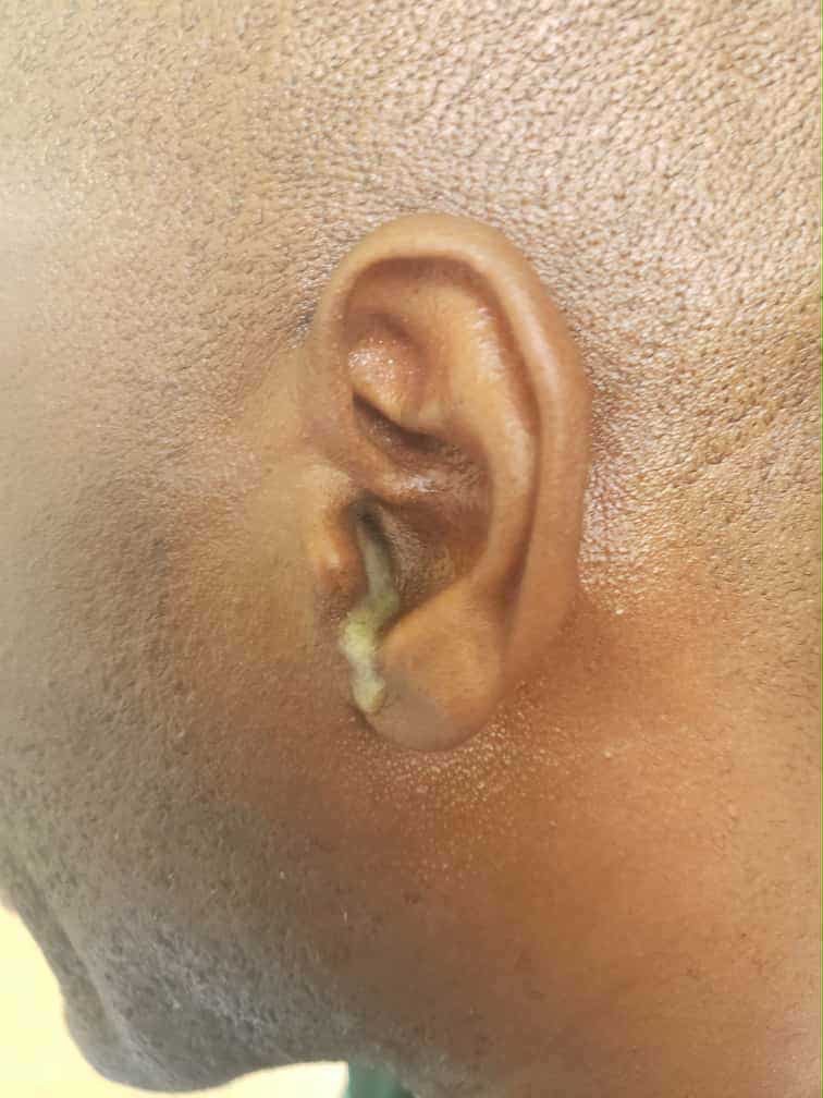 Help Pastor Jean Paul Get Lifesaving Ear Surgery campaign photo, 2 of 5