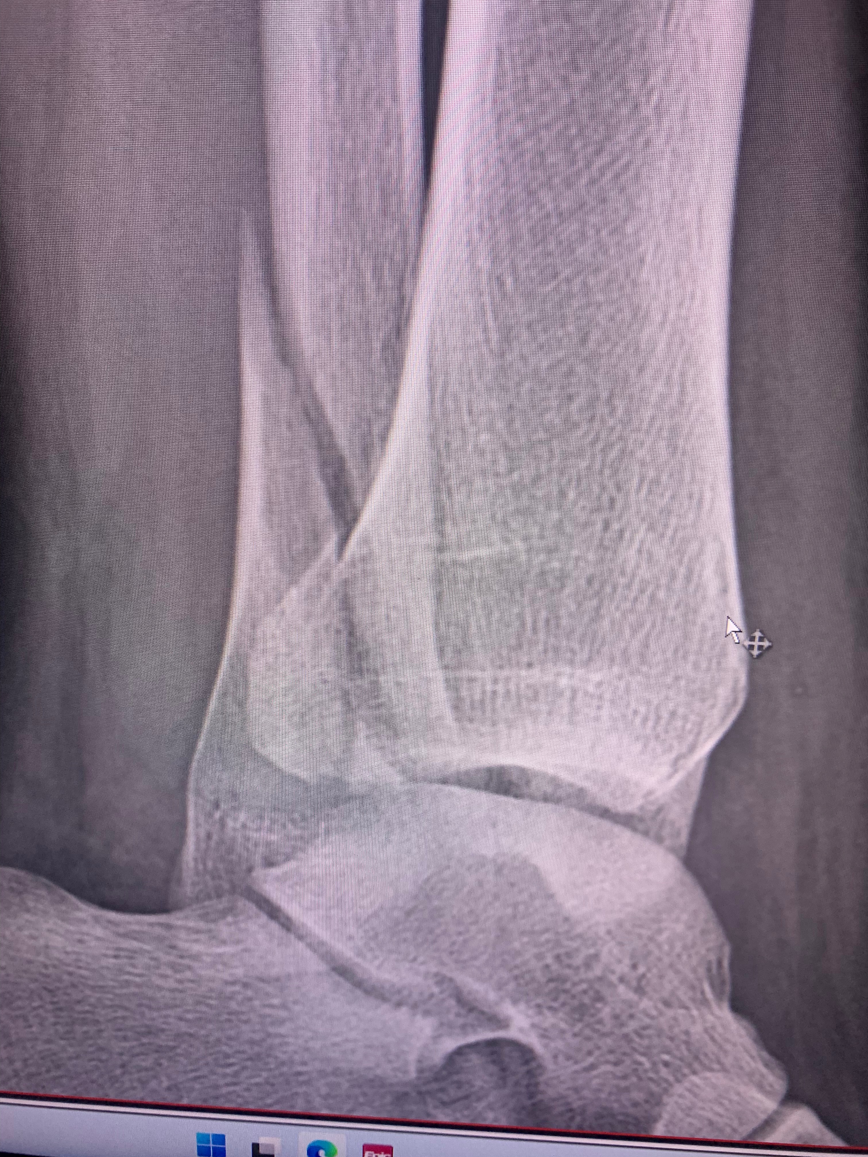 Support My Healing Journey After Ankle Surgery in the U.S. campaign photo, 4 of 7