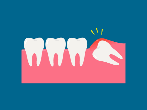 Raising funds for Wisdom Teeth Surgery campaign photo, 2 of 4