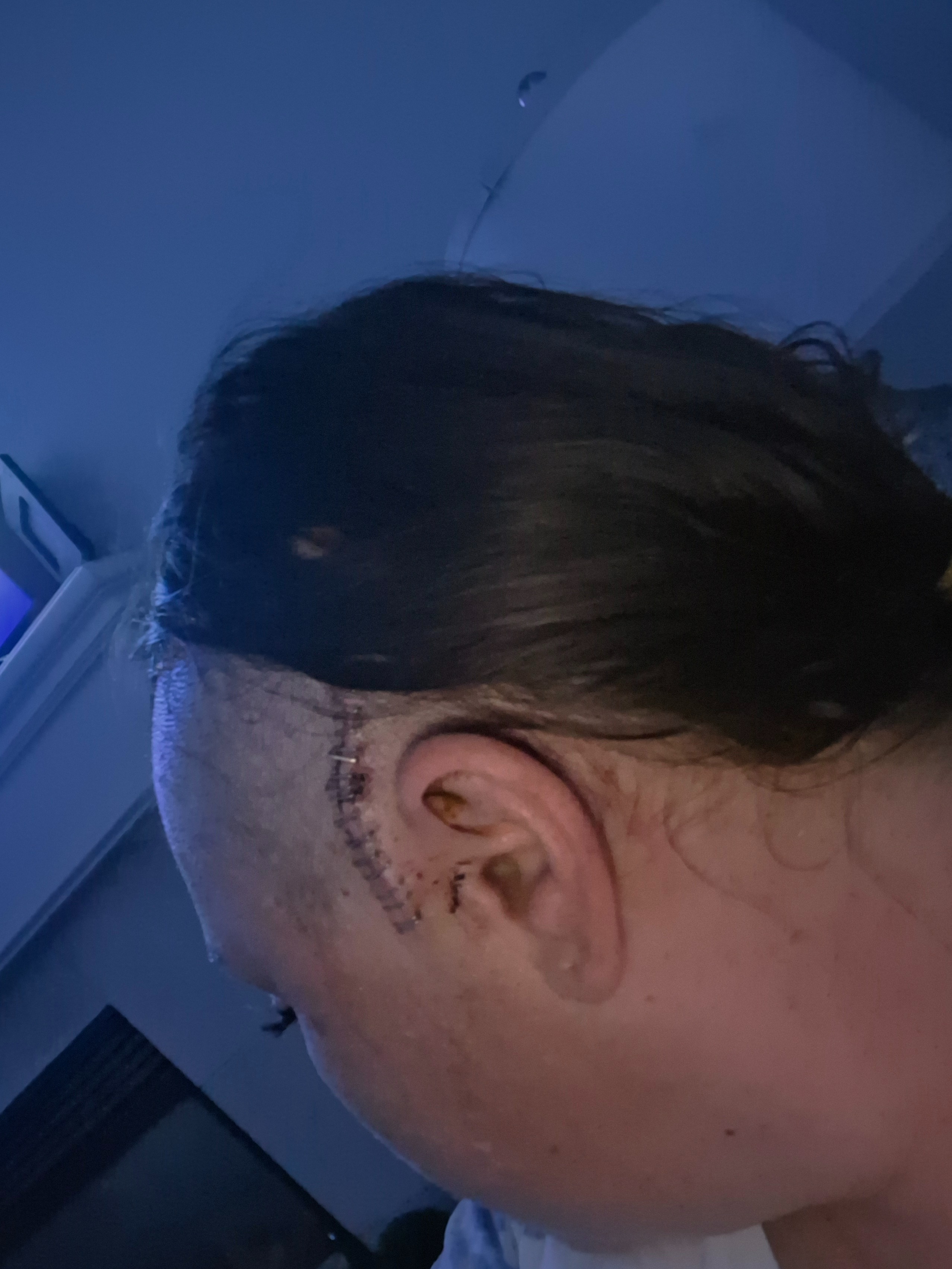 Stage 4 melanoma with a brain mass just removed.. campaign photo, 2 of 8