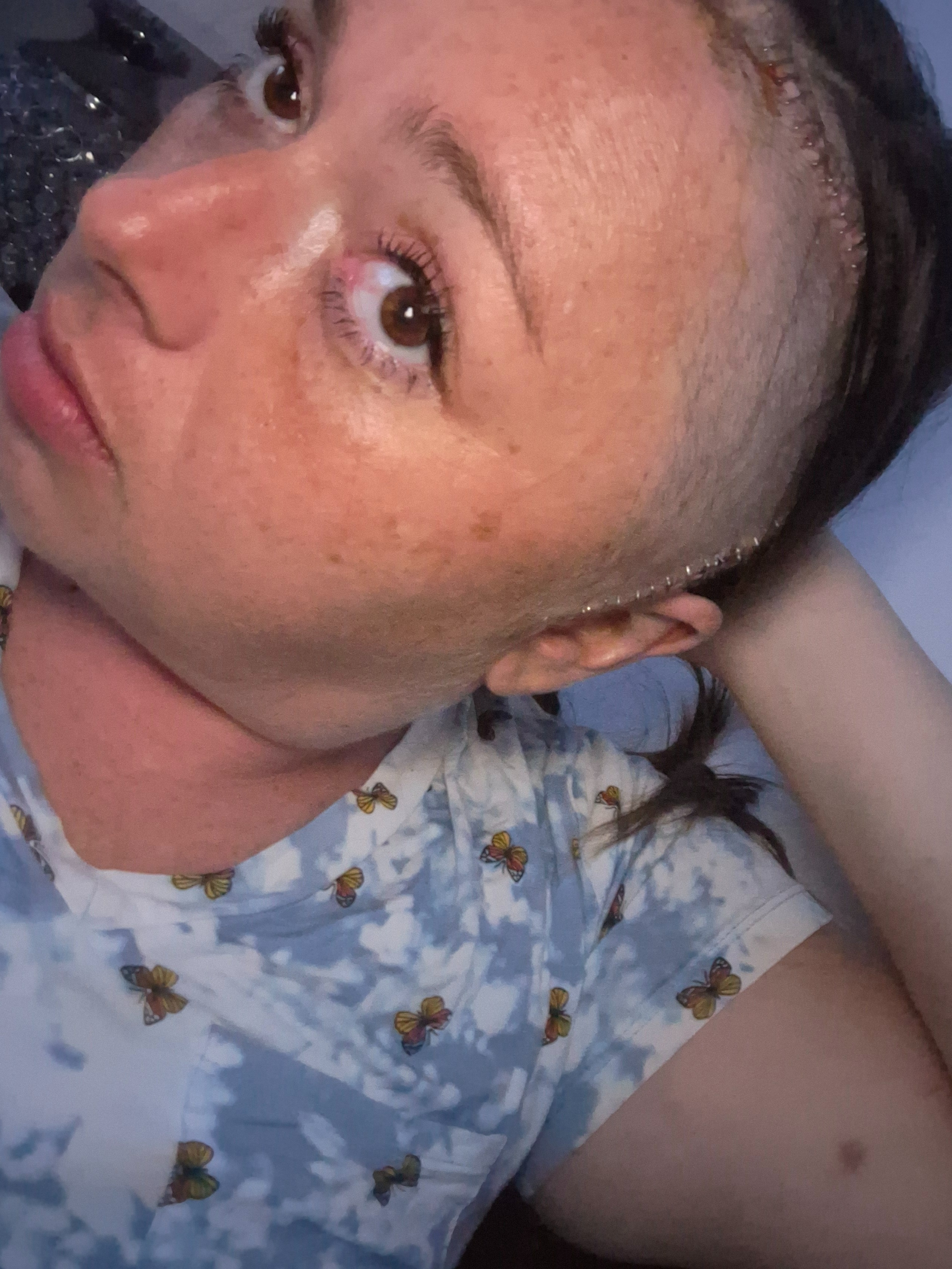Stage 4 melanoma with a brain mass just removed.. campaign photo, 4 of 8