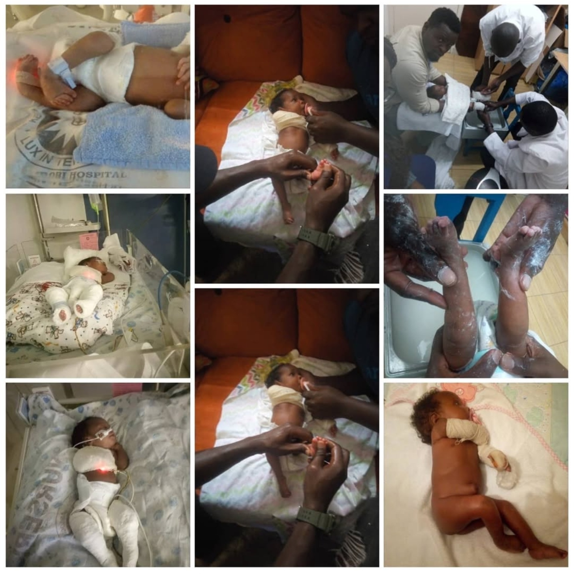 Small Feet, Big Future: A diaper drive for clubfoot babies campaign photo, 5 of 7