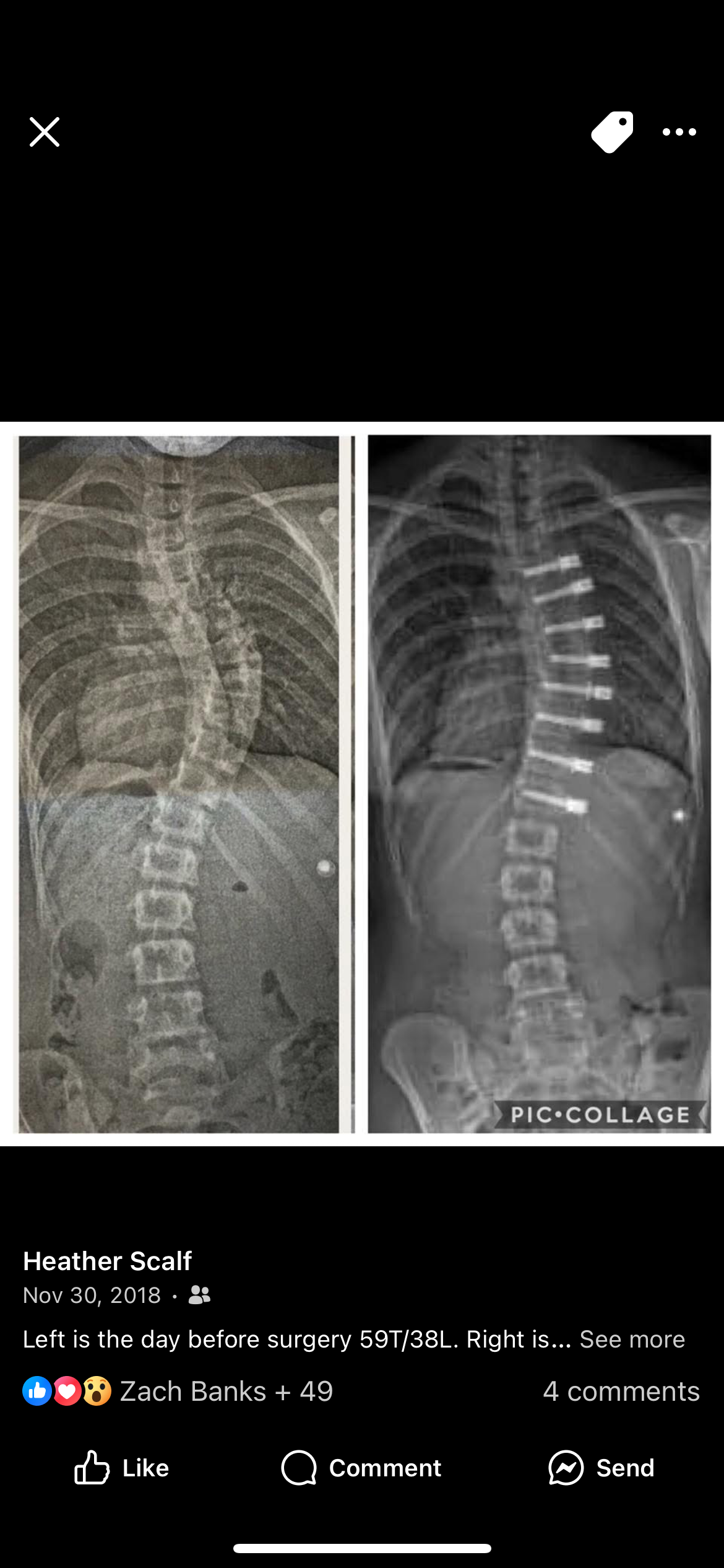 Support Kylie’s Spinal Fusion Surgery campaign photo, 7 of 7