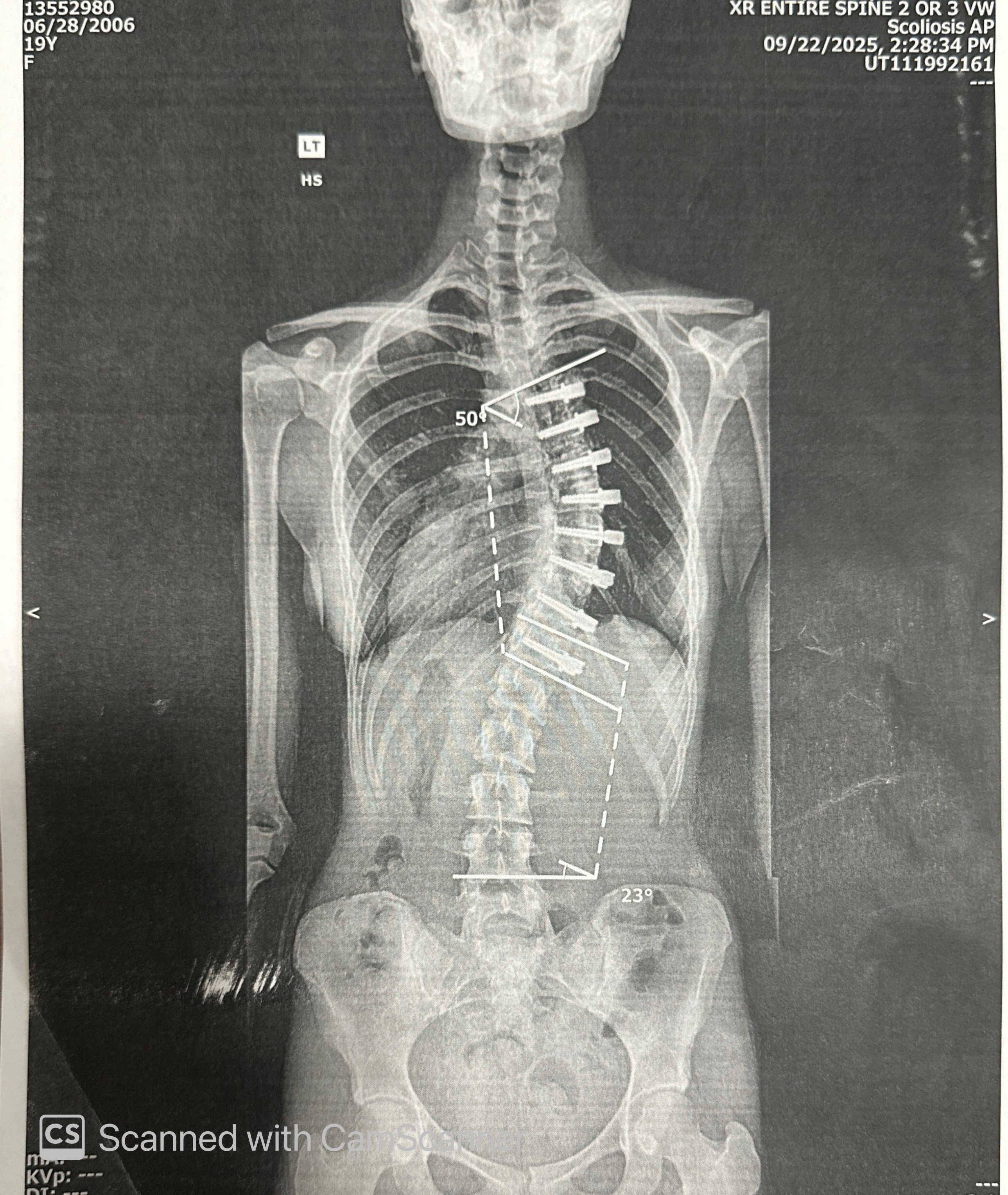 Support Kylie’s Spinal Fusion Surgery campaign photo, 2 of 7