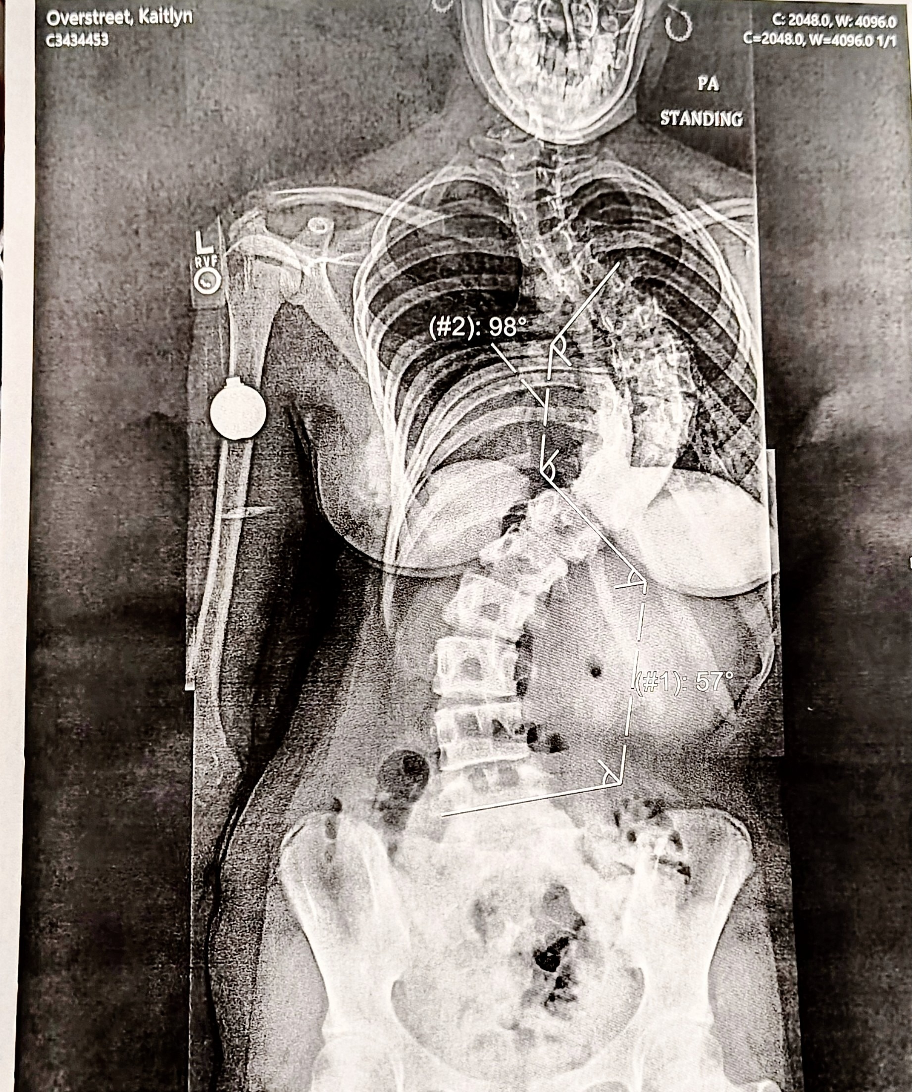 Donate to Madison's Life-Changing Surgeries campaign photo, 5 of 7