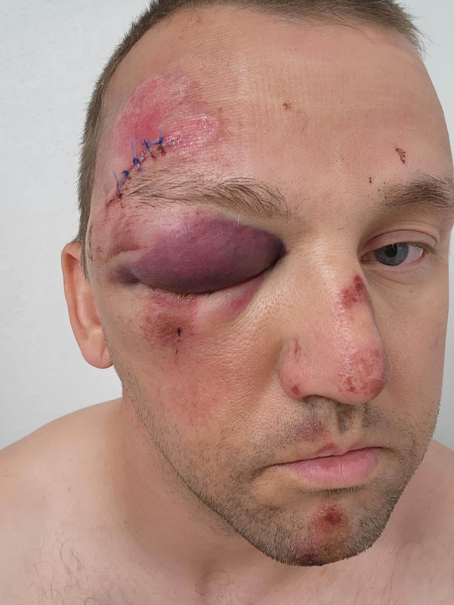 Help me survive medical debt from my July 11th 2024 accident campaign photo, 5 of 6