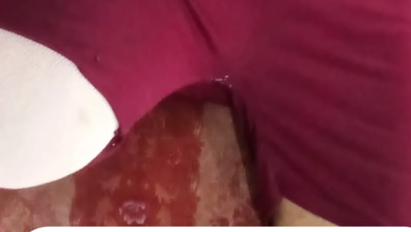 تبرع لمساعدتي مريض بتر قدمي اليمين photo