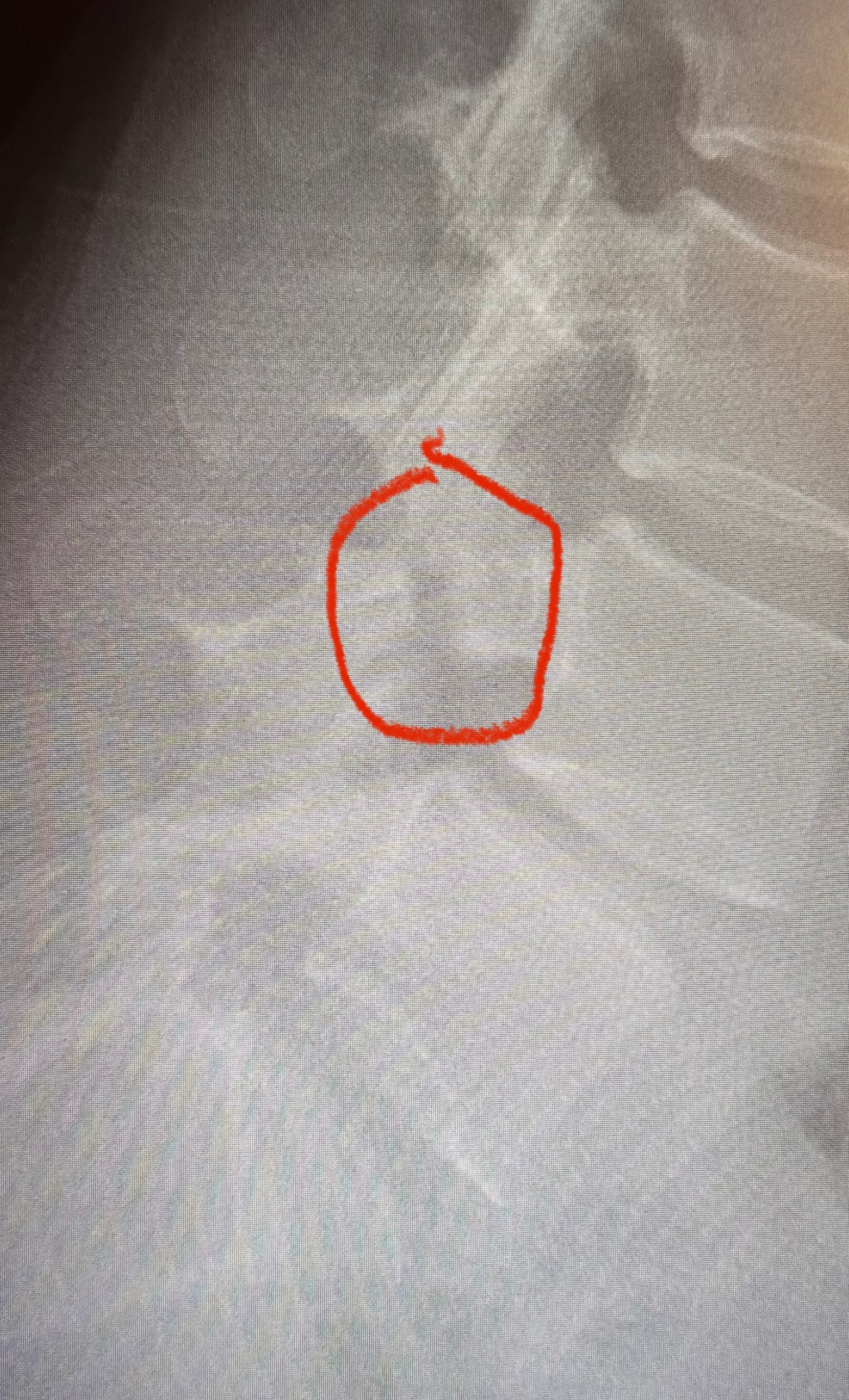 Hilary Anderson needs back surgery campaign photo, 2 of 6