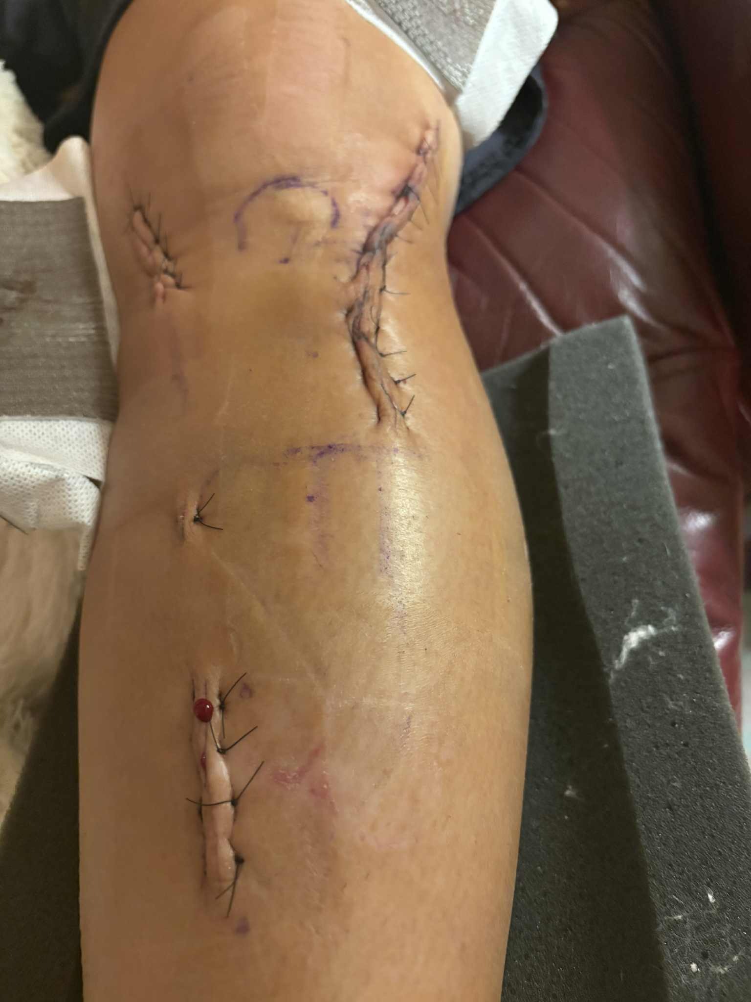 Help Jessie Schuerman Recover from Injury campaign photo, 2 of 8