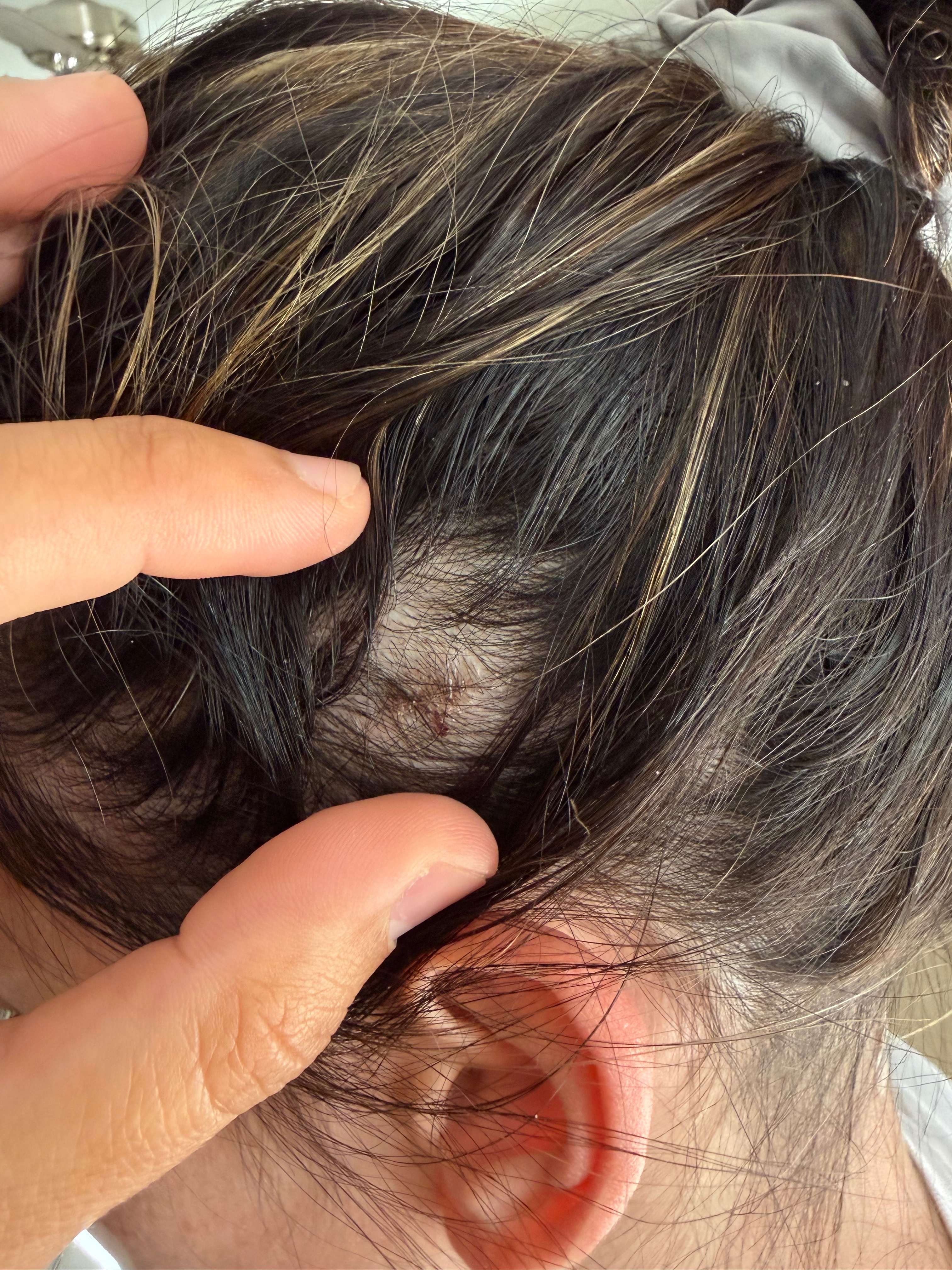 Support Ashley's Journey to Migraine Relief campaign photo, 5 of 8