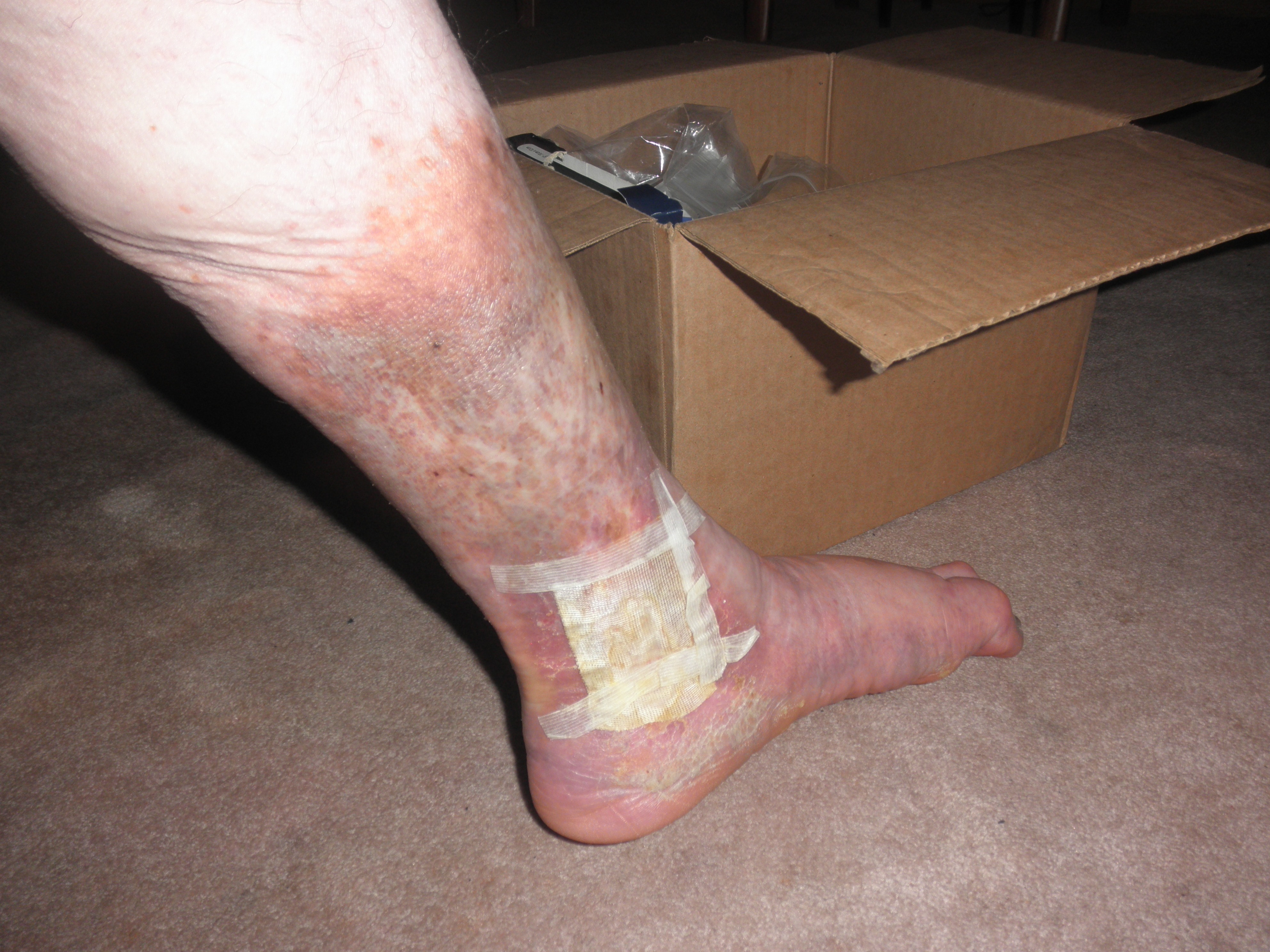Support Joseph's Battle with Chronic Venous Insufficiency campaign photo, 2 of 7