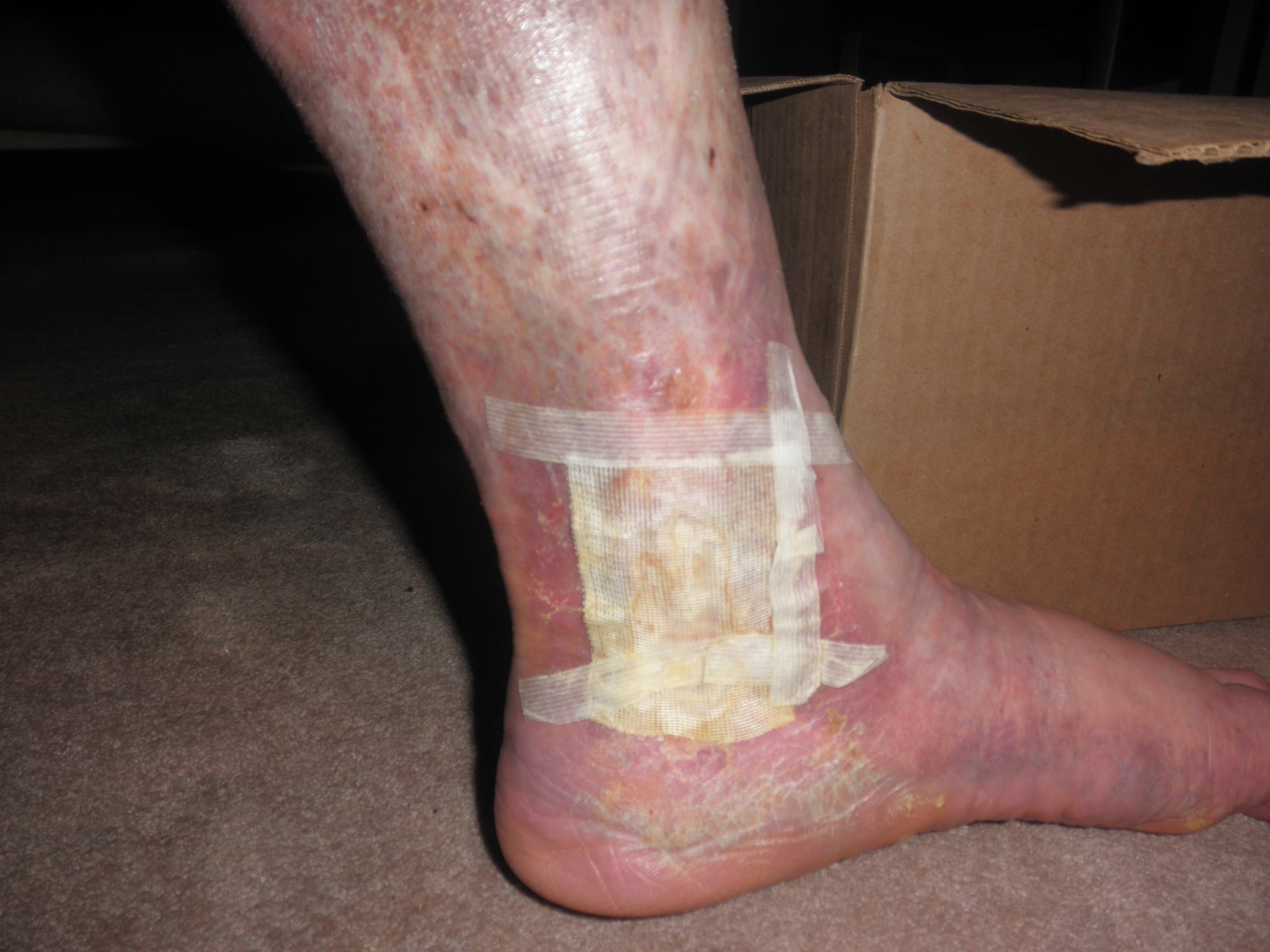 Support Joseph's Battle with Chronic Venous Insufficiency campaign photo, 4 of 7