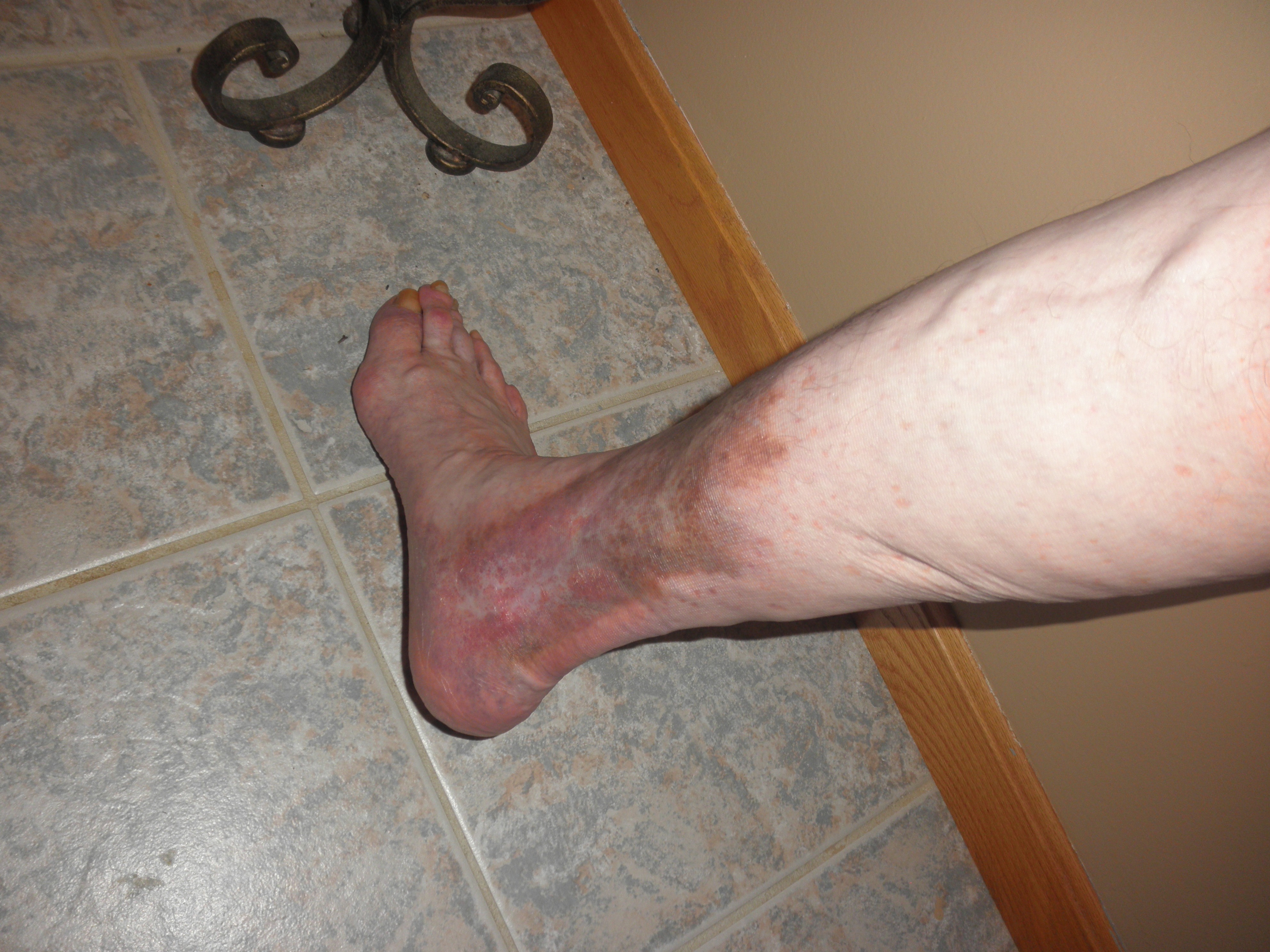 Support Joseph's Battle with Chronic Venous Insufficiency campaign photo, 5 of 7