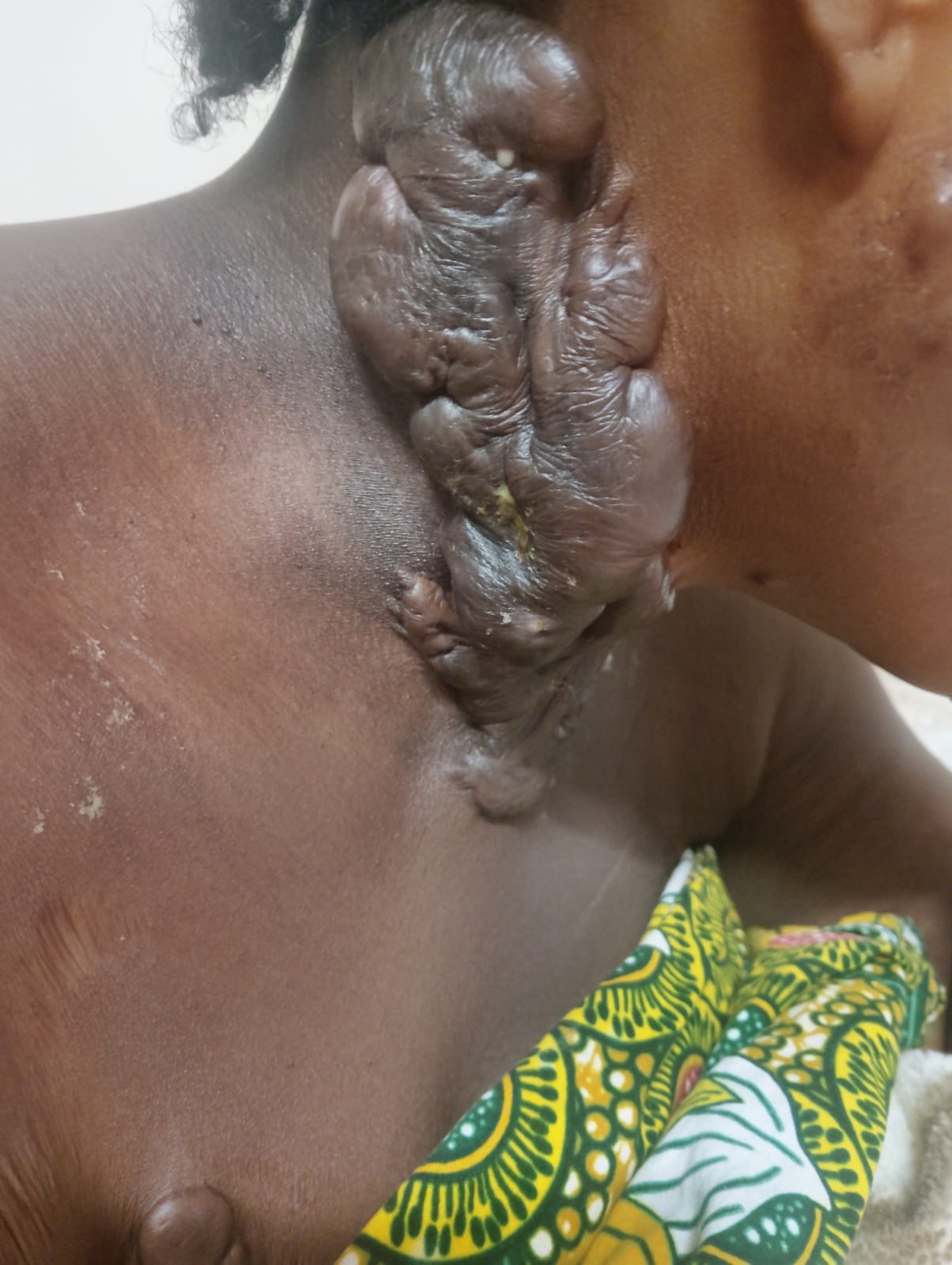Give Anastasia hope: urgent keloid surgery needed campaign photo, 2 of 8