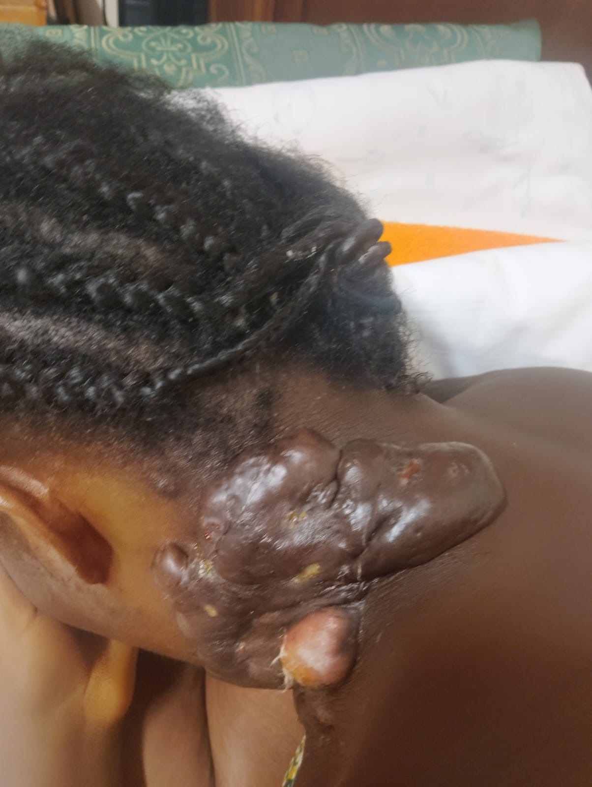 Give Anastasia hope: urgent keloid surgery needed campaign photo, 4 of 8