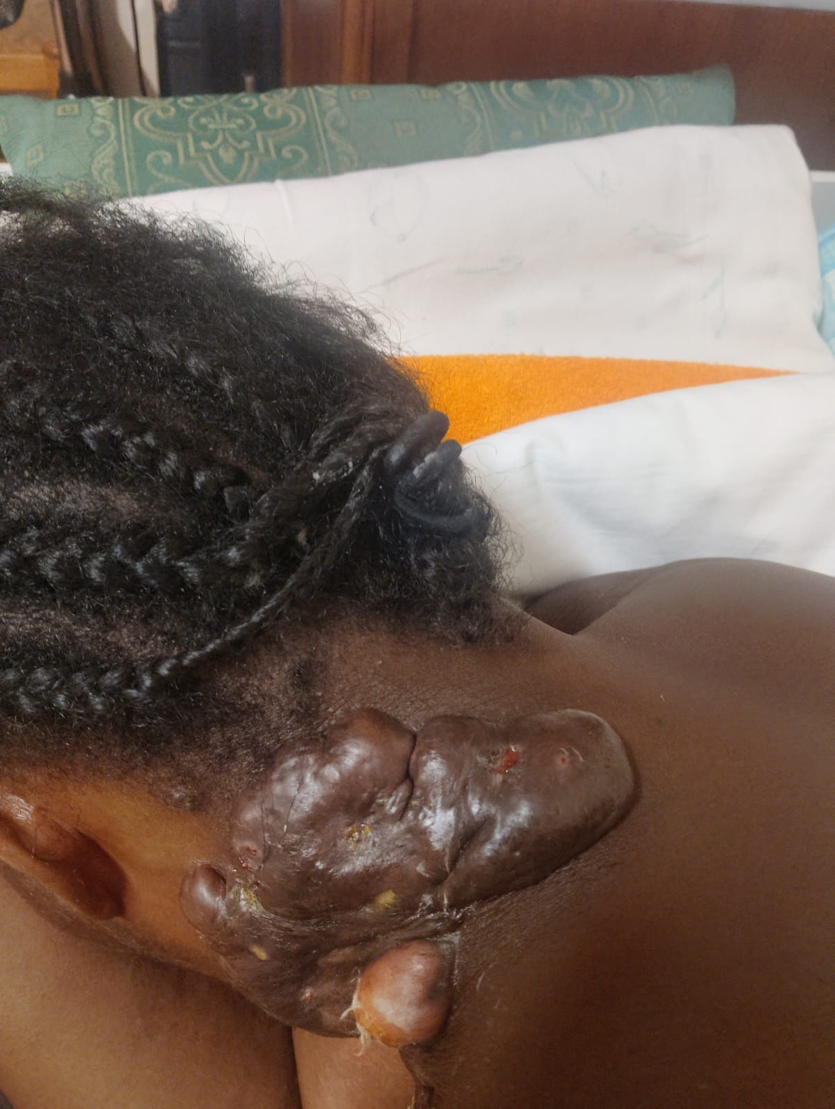 Give Anastasia hope: urgent keloid surgery needed campaign photo, 6 of 8