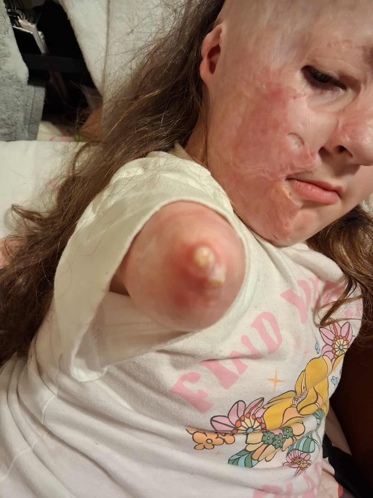 Help My Niece Continue Her Recovery After Tragic Accident campaign photo, 2 of 6
