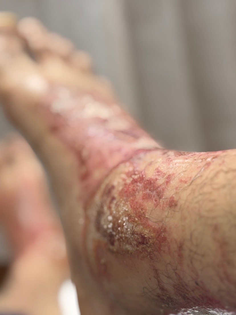 Cement accident, 2-3rd degree burns to feet. Appreciate you. campaign photo, 7 of 8