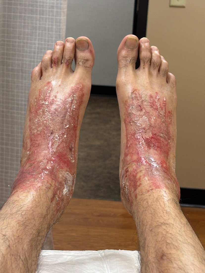Cement accident, 2-3rd degree burns to feet. Appreciate you. campaign photo, 2 of 8