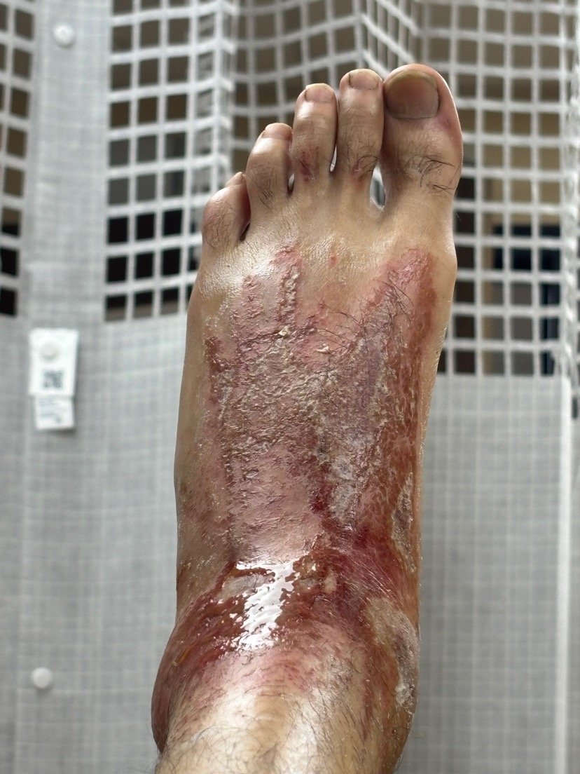 Cement accident, 2-3rd degree burns to feet. Appreciate you. campaign photo, 5 of 8