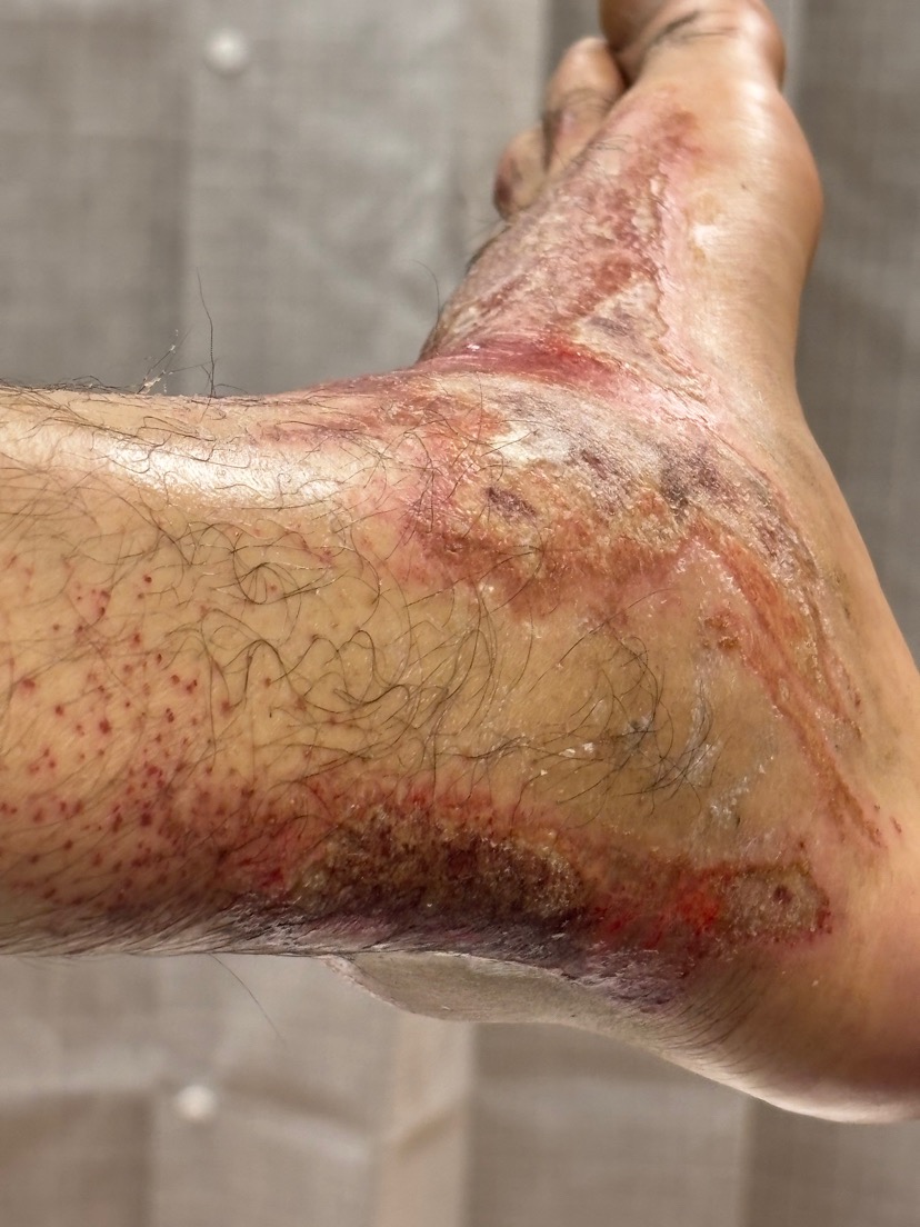 Cement accident, 2-3rd degree burns to feet. Appreciate you. campaign photo, 4 of 8