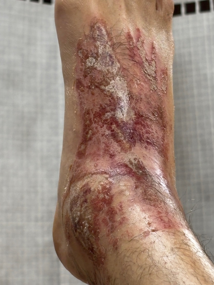 Cement accident, 2-3rd degree burns to feet. Appreciate you. campaign photo, 6 of 8