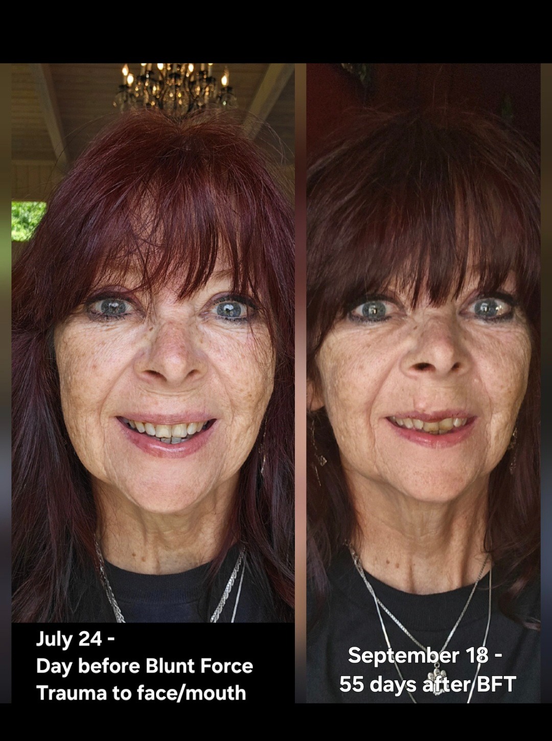 Help Support Diana's Dental Expense From Blunt Force Trauma campaign photo, 5 of 8
