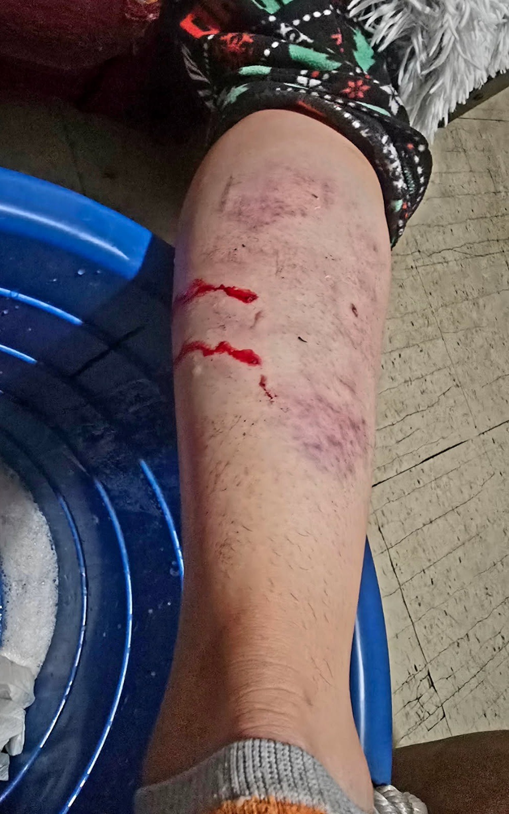 Help Leo and Lupita overcome severe injuries and hardships campaign photo, 4 of 8
