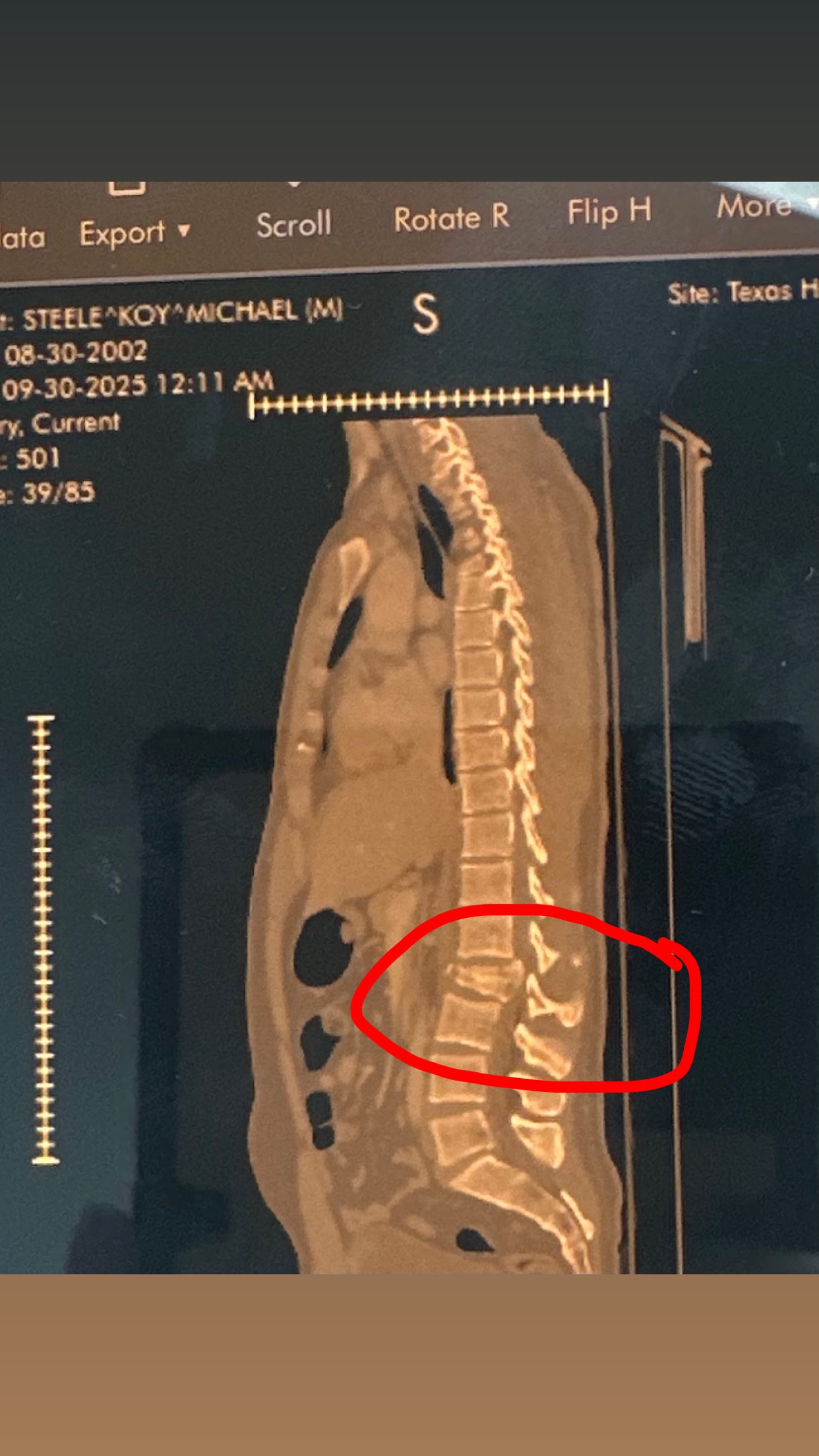Support Koy Steele's Spinal Surgery Recovery campaign photo, 4 of 5