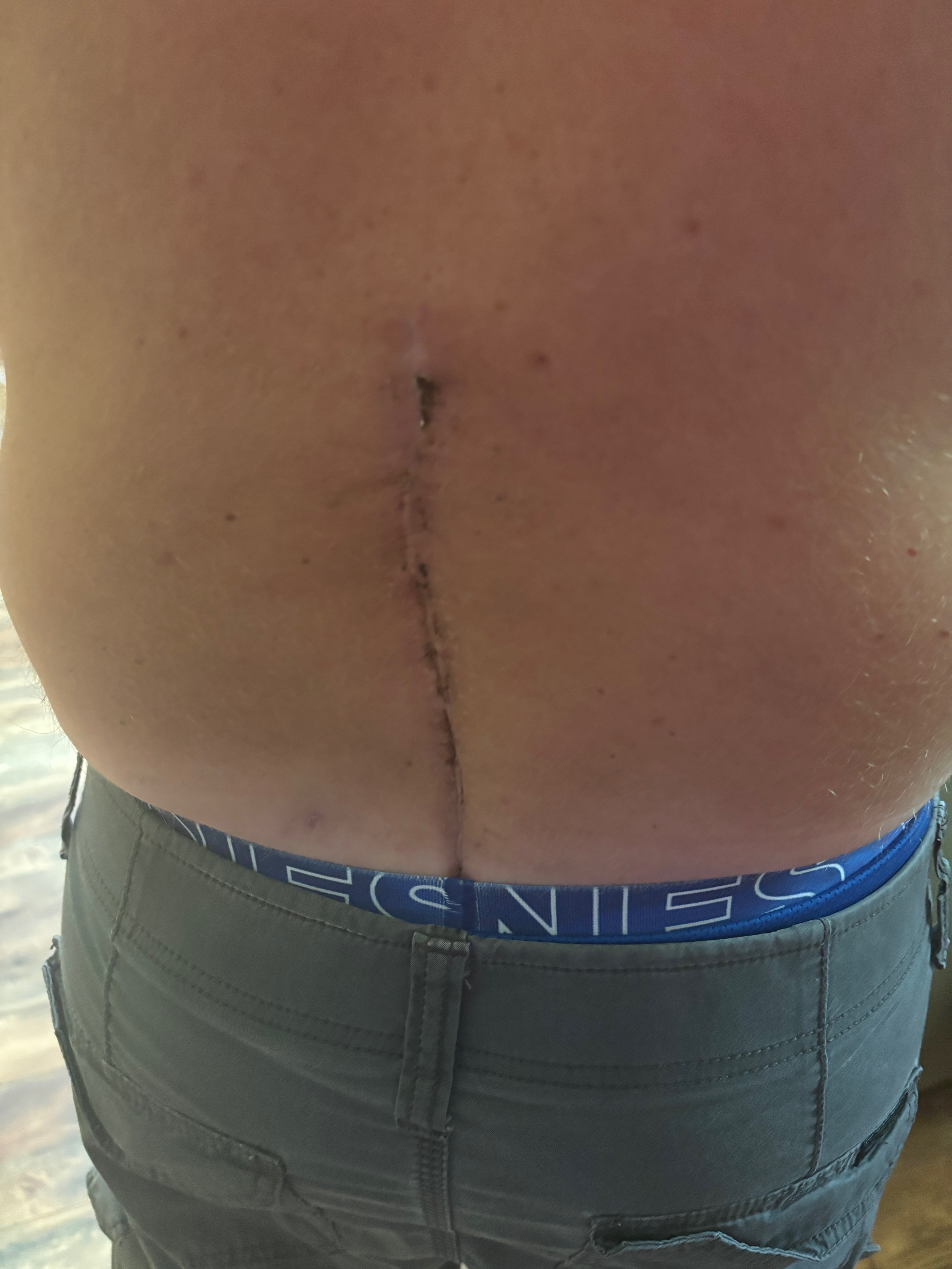 Support Jerome's Battle with Failed Surgeries campaign photo, 2 of 8