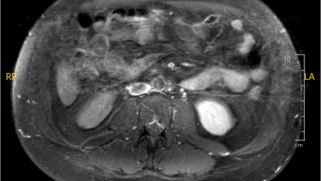 Urgent Surgery Needed: Help Me Remove a Dangerous Lump photo
