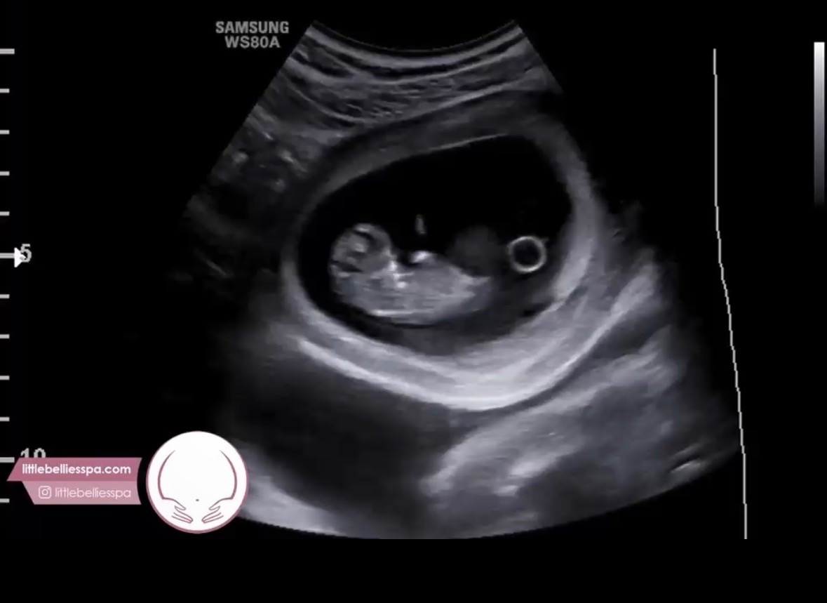 Help a Grieving Mother Bury Her Baby campaign photo, 2 of 3