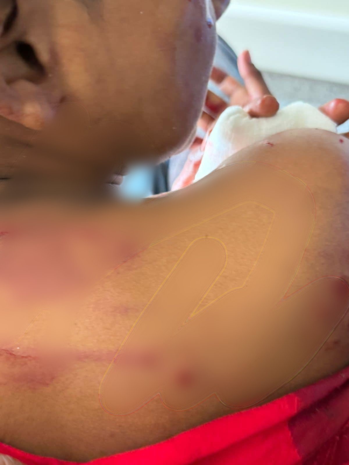 Help Ravin Recover from Rottweiler Attack campaign photo, 6 of 7