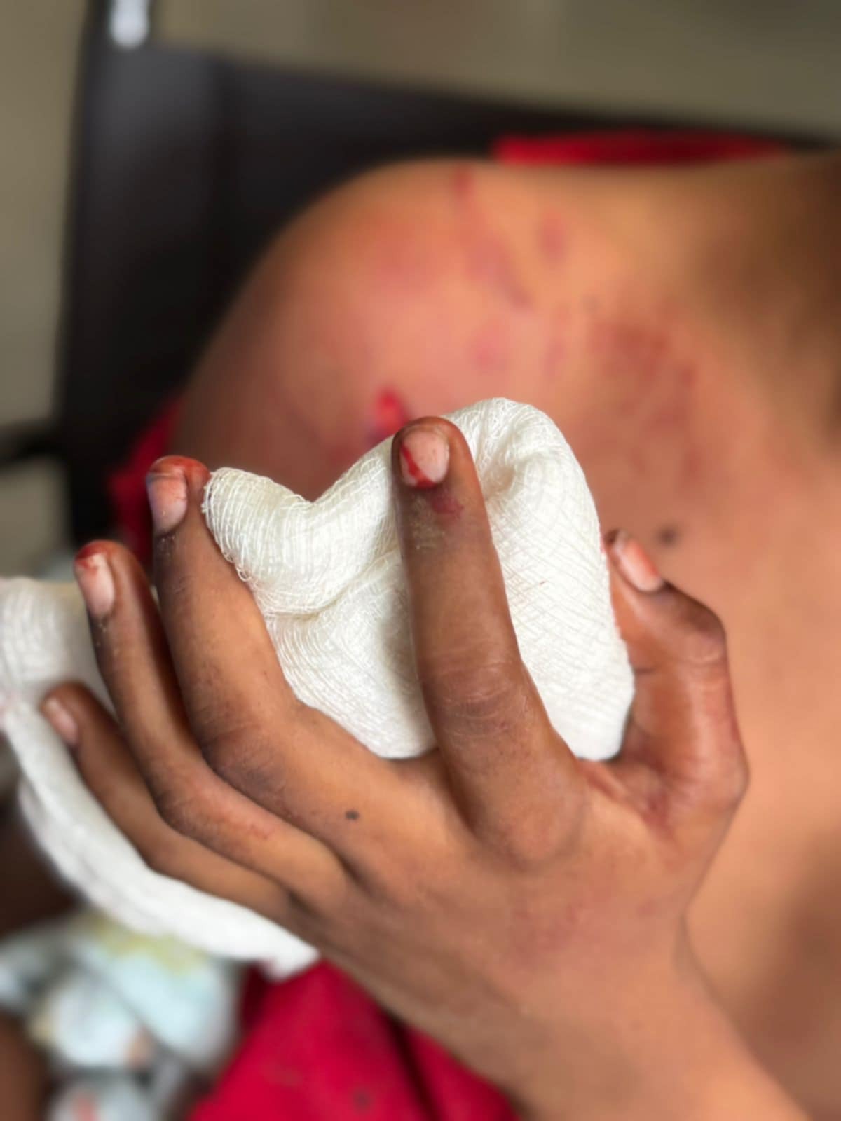 Help Ravin Recover from Rottweiler Attack campaign photo, 4 of 7